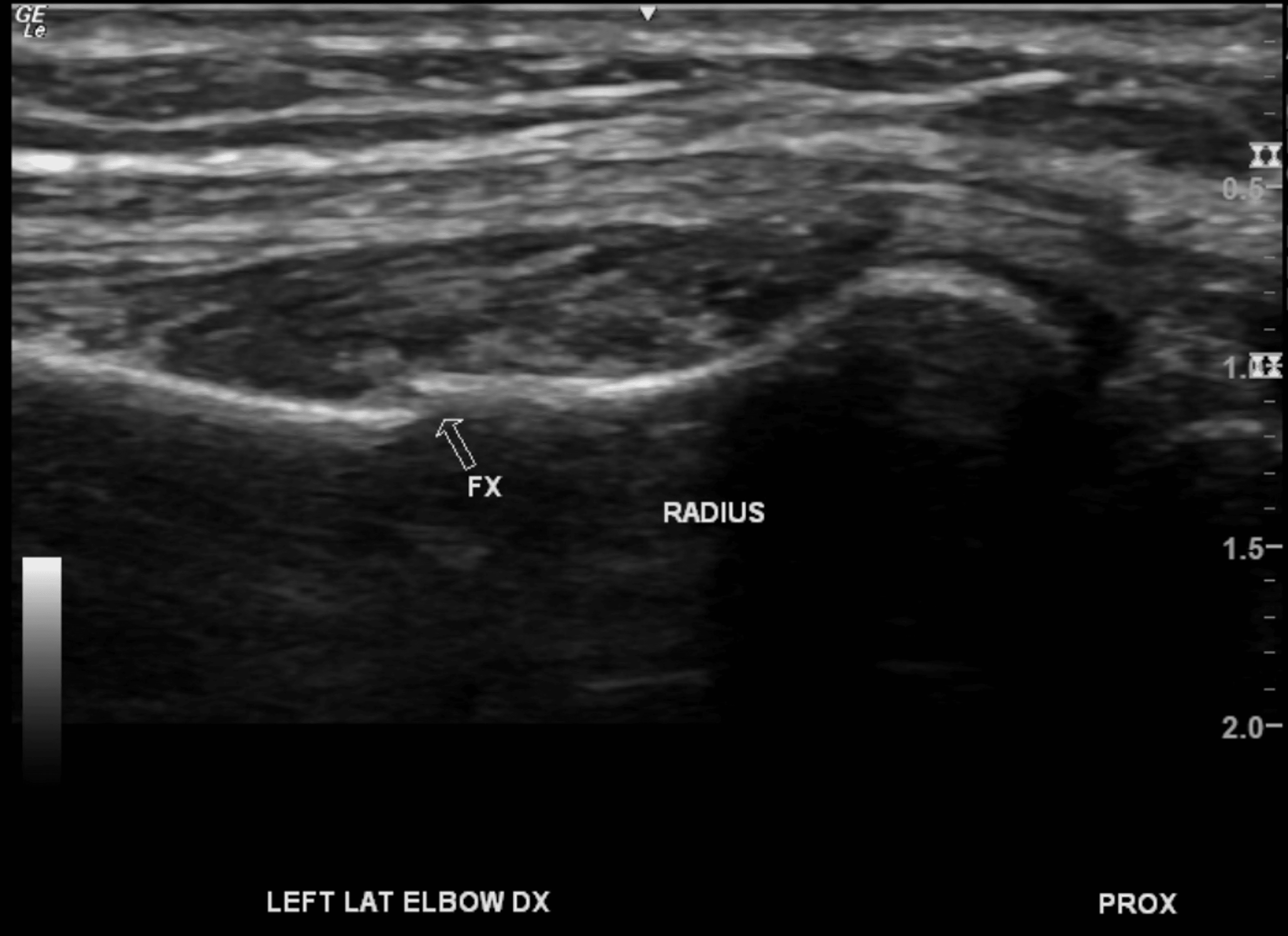 Cureus Snowed In A Case Report on the Utilization of Ultrasound in