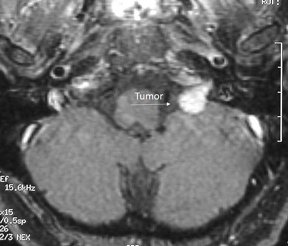 Case study 42 intracranial neoplasm 05 image