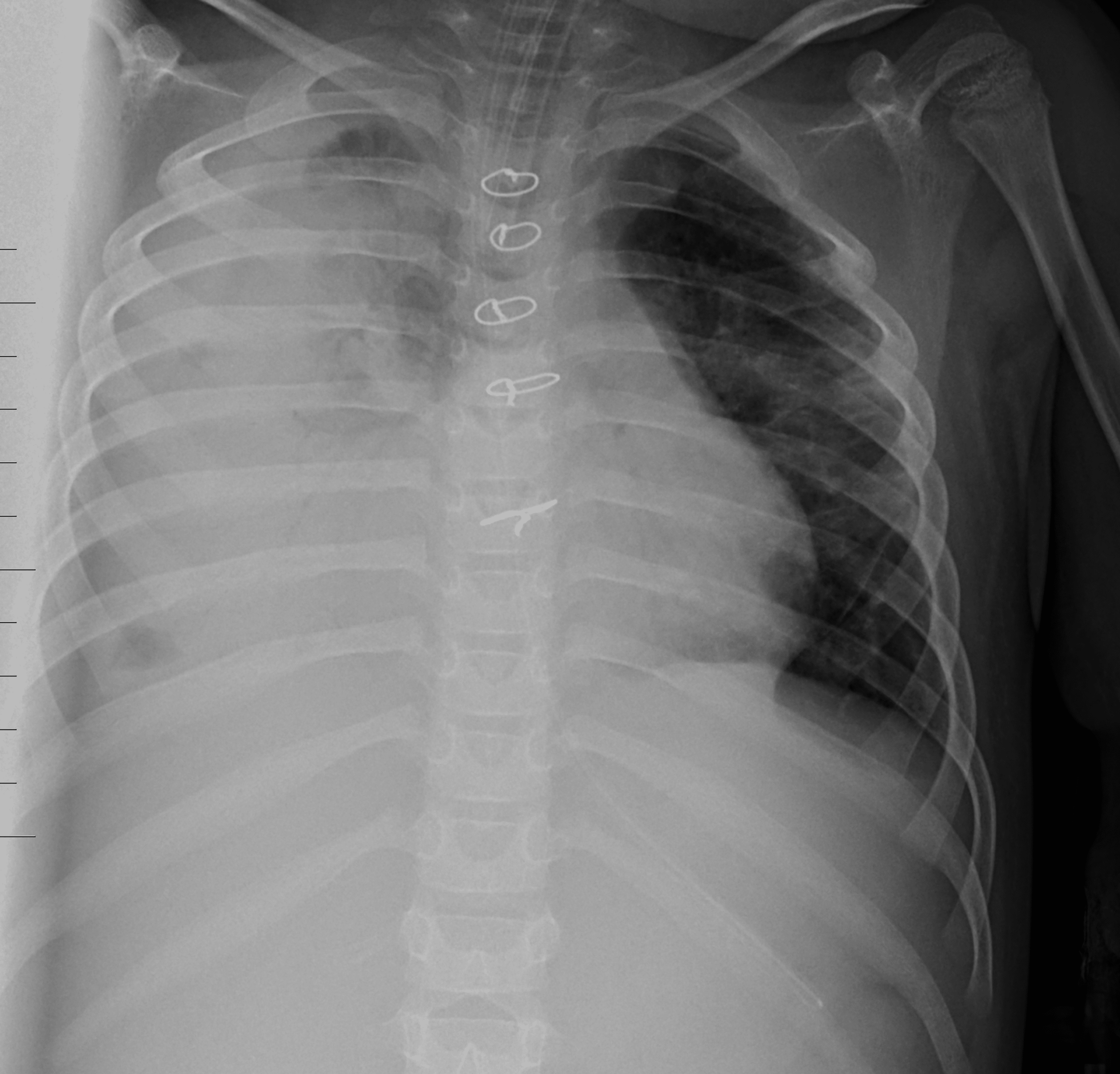 Mucus In Lungs X Ray