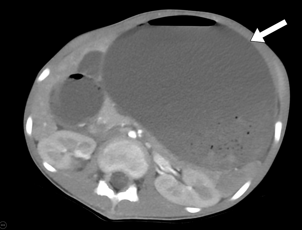 Axial-CT-scan-of-the-abdomen-shows-a-markedly-fluid-filled-stomach-(arrow)-causing-a-significant-mass-effect-on-the-left-kidney-and-adjacent-bowel-loops.
