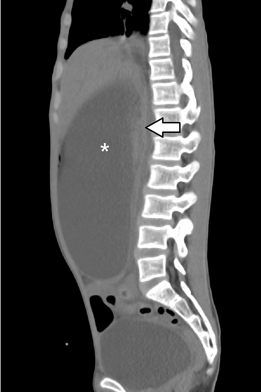 Sagittal-CT-scan-of-the-abdominopelvic-cavity-shows-a-markedly-distended-stomach-(asterisk)-with-a-narrow-aortomesenteric-distance-(arrow)-consistent-with-superior-mesenteric-artery-syndrome.