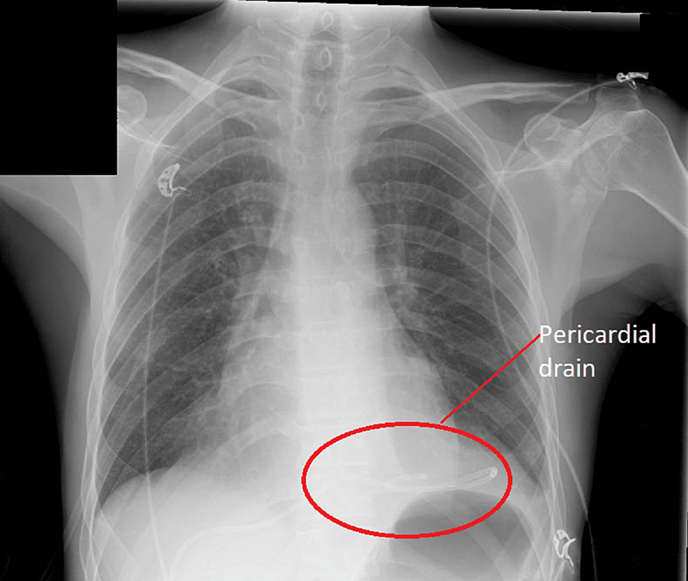 Subacute Cardiac Tamponade With Massive Pericardial Effusion Cureus