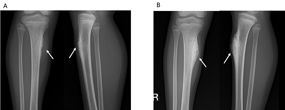 Usefulness of Quantitative Bone Single Photon Emission Computed ...