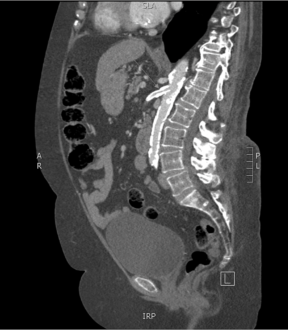 Cureus Chronic Mesenteric Ischemia in a Patient With Limited Systemic
