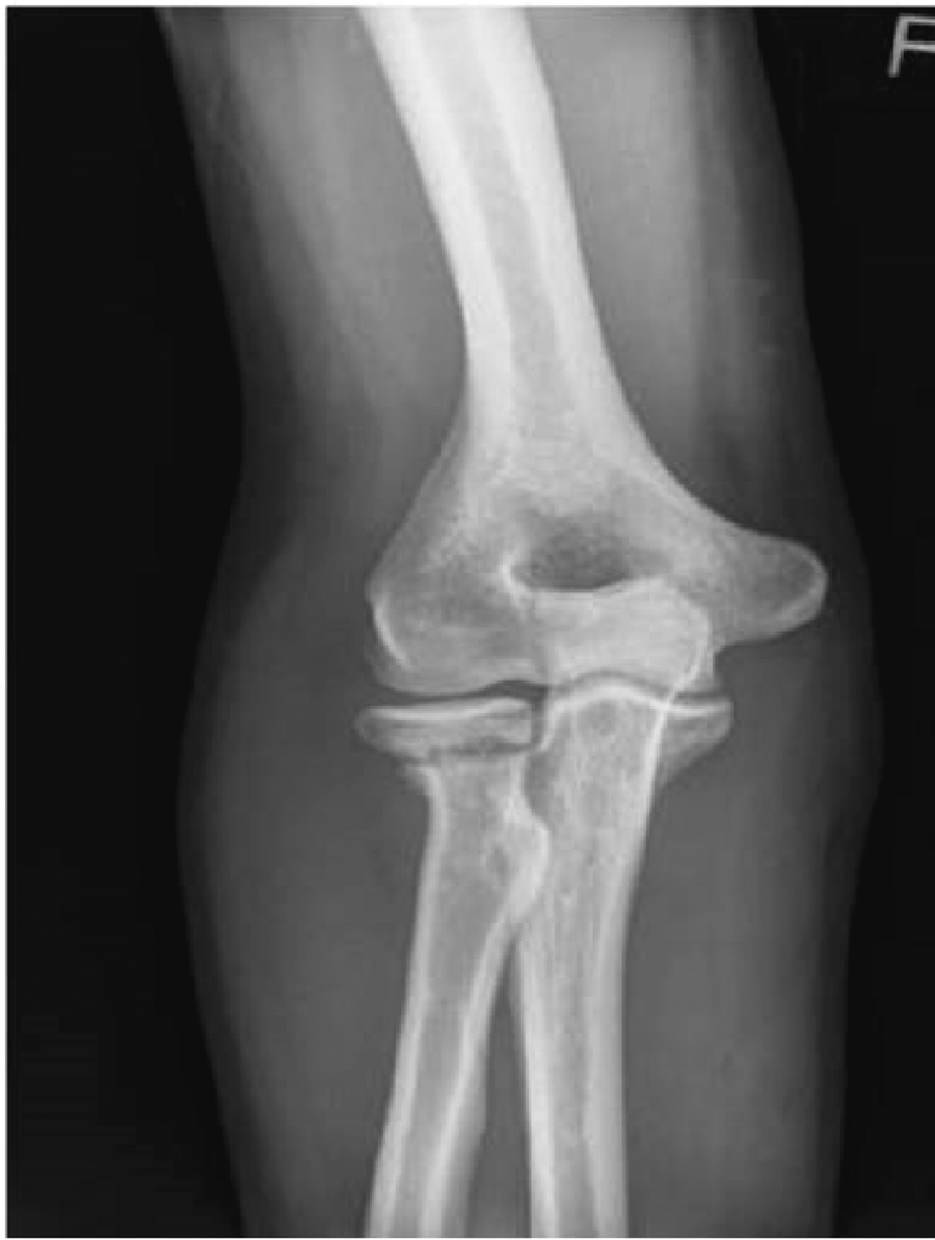 Cureus | Non-union of Conservatively Managed Radial Neck Fractures in ...