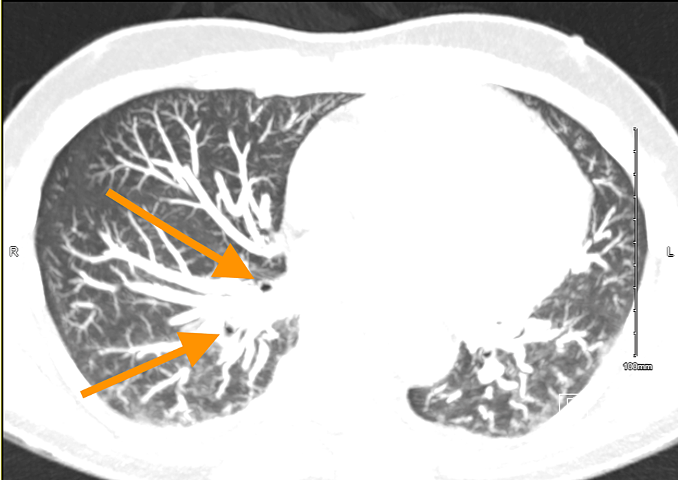 cureus-lessons-learned-from-a-case-of-behcet-s-disease-presenting