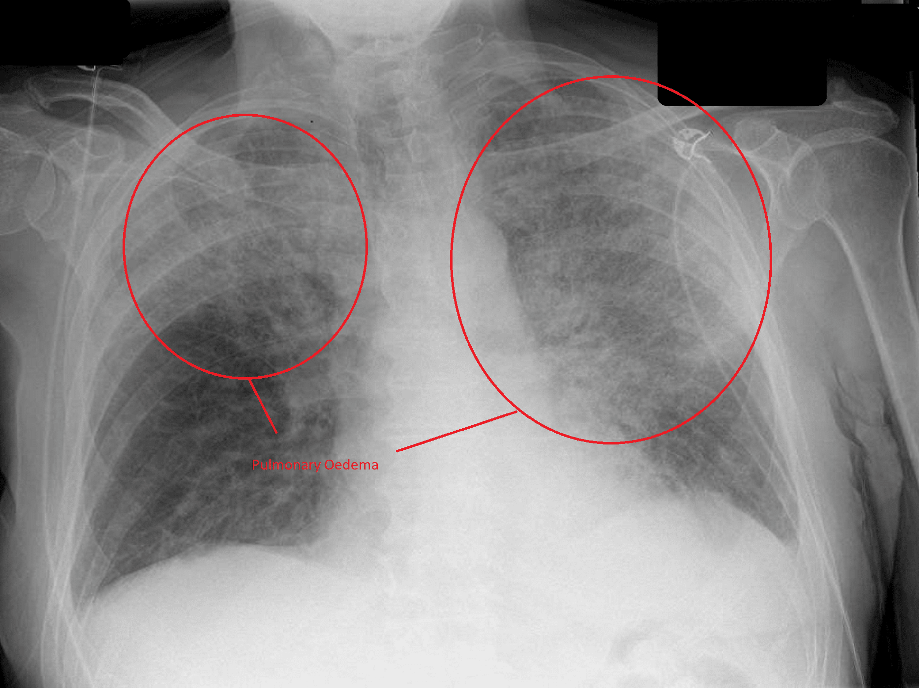 Cureus Bilateral Upper Lobe Pulmonary Oedema and Primary Mitral
