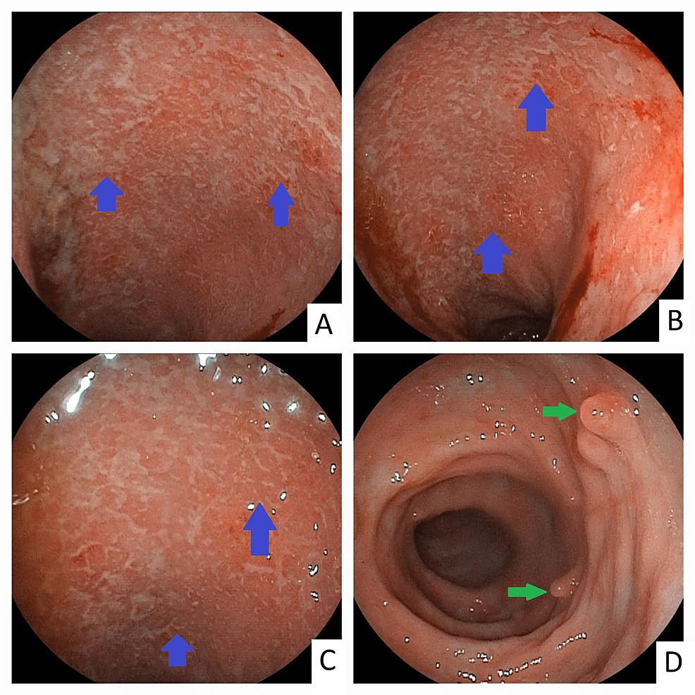 Endoscopic-view-of-Mayo-3-proctosigmoiditis-with-significant-mucosal-granularity-and-ulcerations-with-spontaneous-bleeding-(blue-arrows;-panels-A,-B,-and-C)-with-multiple-pseudopolyps--(green-arrows,-panel-D)