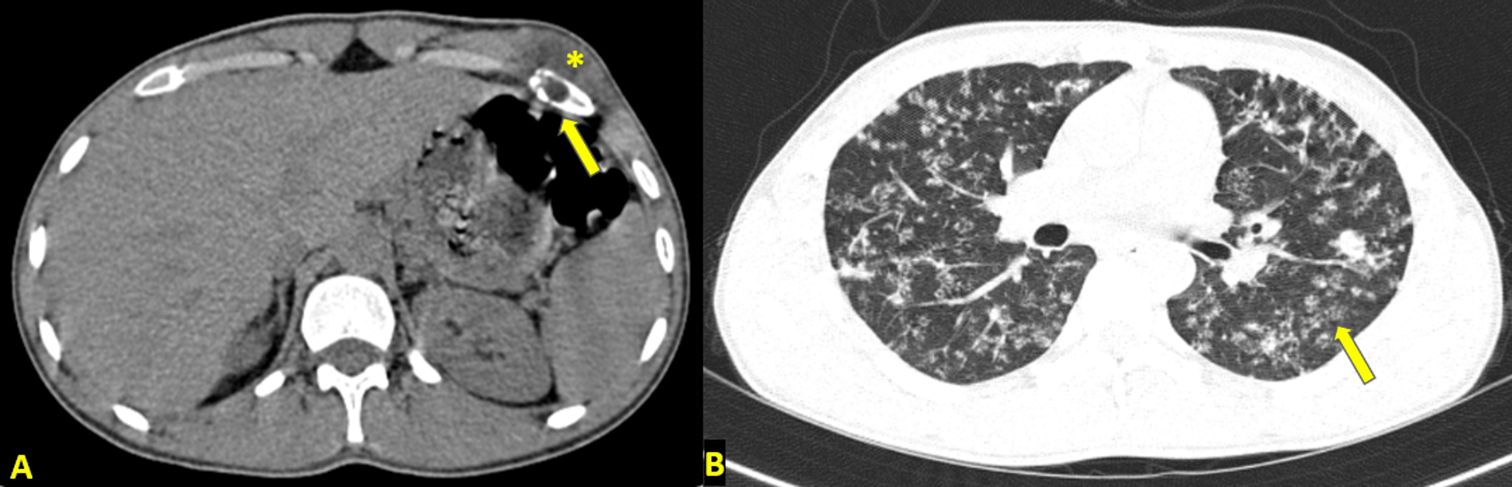 Cureus Radiological Evaluation of a Rare Case of Rib Caries and Cold