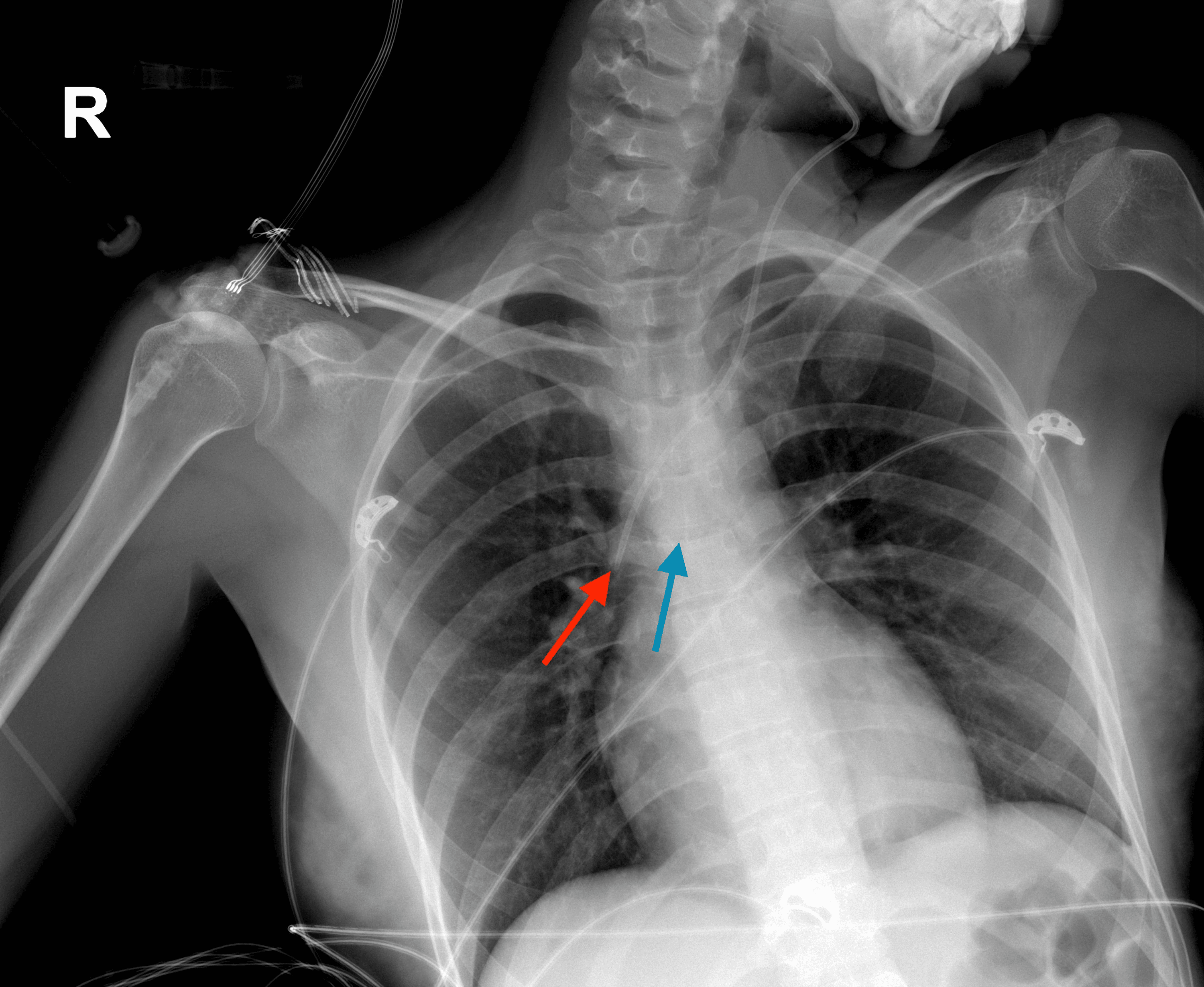 Assessment of the Tip Position of Central Venous Catheters Inserted