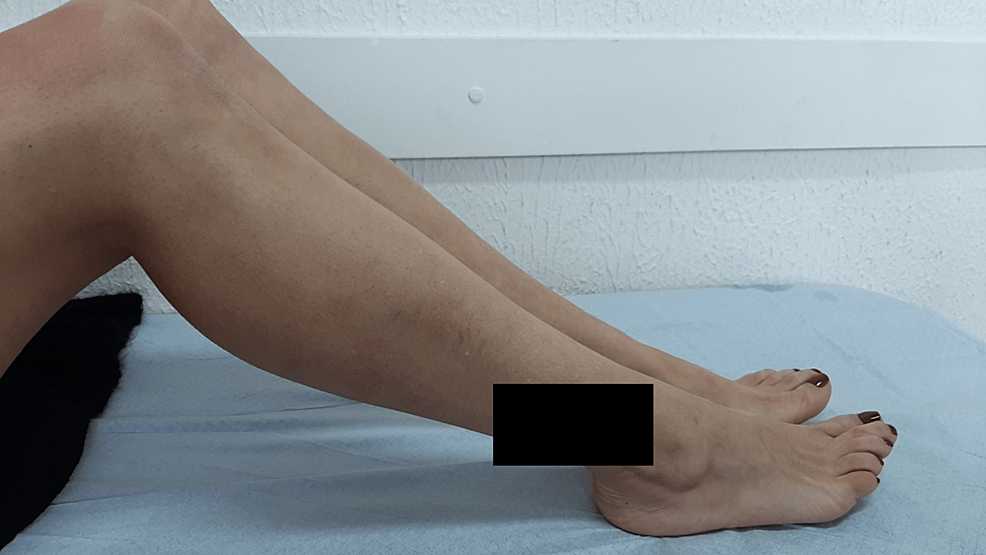 Lateral-perspective-of-the-legs-of-the-patient-after-initiating-isoniazid-(four-month-follow-up-period)