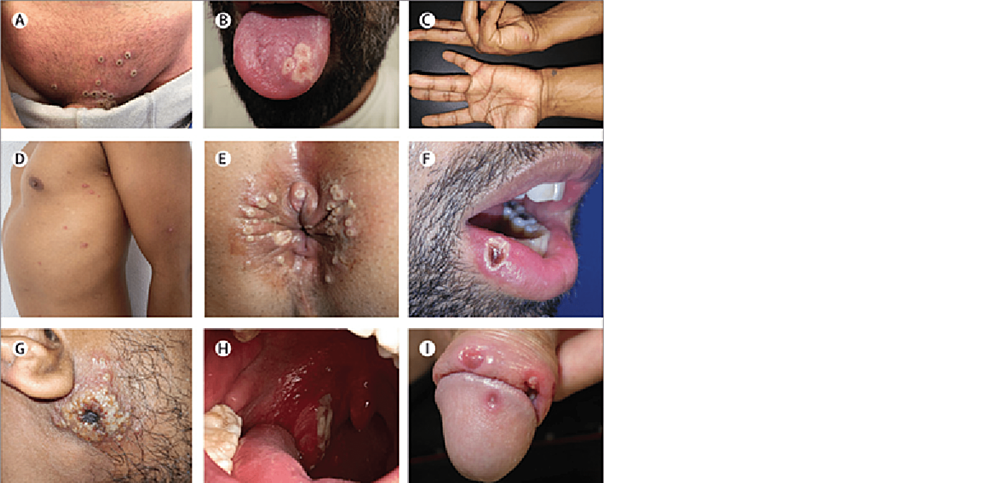 A)-Pustules-in-the-genital-region.-B)-Pustular-lesions-on-the-left-side-of-the-tongue.-C)-Pearly-vesicles-in-the-palmar-skin-of-the-hands.-D)-Scattered-papules-and-pustules-with-an-erythematous-halo.-E)-Pustules-in-the-anal-and-perianal-skin.-F)-Pustular-lesion-on-the-lower-lip.-G)-Primary-inoculation-site-with-a-large-crusted-lesion.-H)-Fibrin-covered-ulcer-on-the-right-tonsil.-I)-Lesions-on-the-penile-glans-and-foreskin.