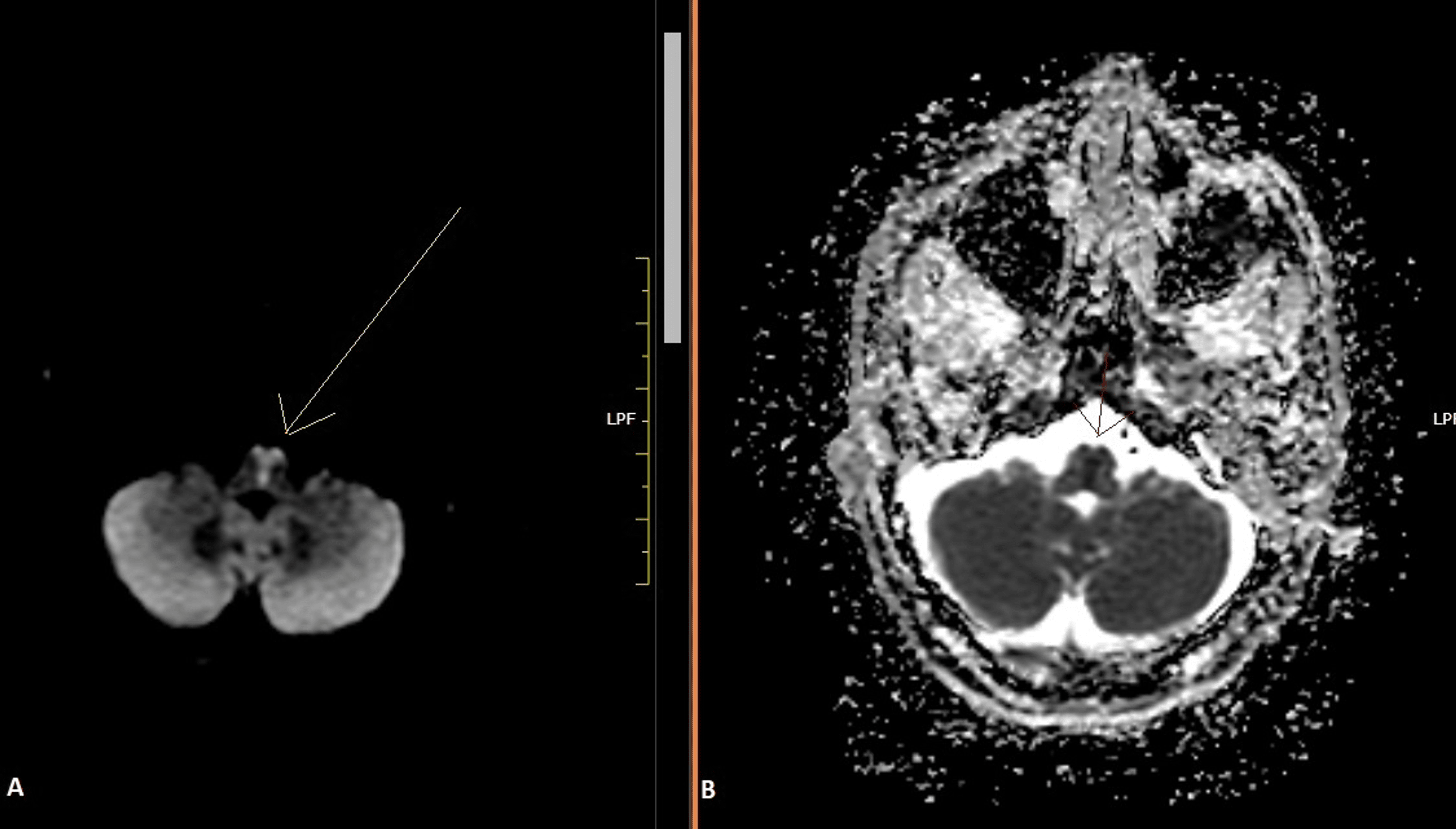 Sprog mirakel isolation Cureus | Airpod Sign: A Diagnostic Radiological Finding of a Rare  Cerebrovascular Accident | Article