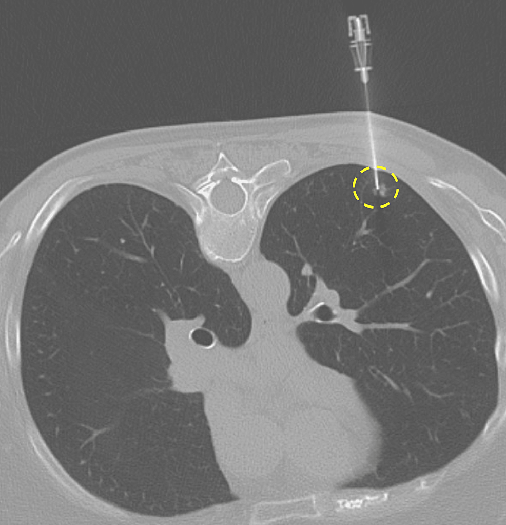 Cureus Left Heart And Systemic Arterial Circulation Air Embolus During Ct Guided Lung Biopsy