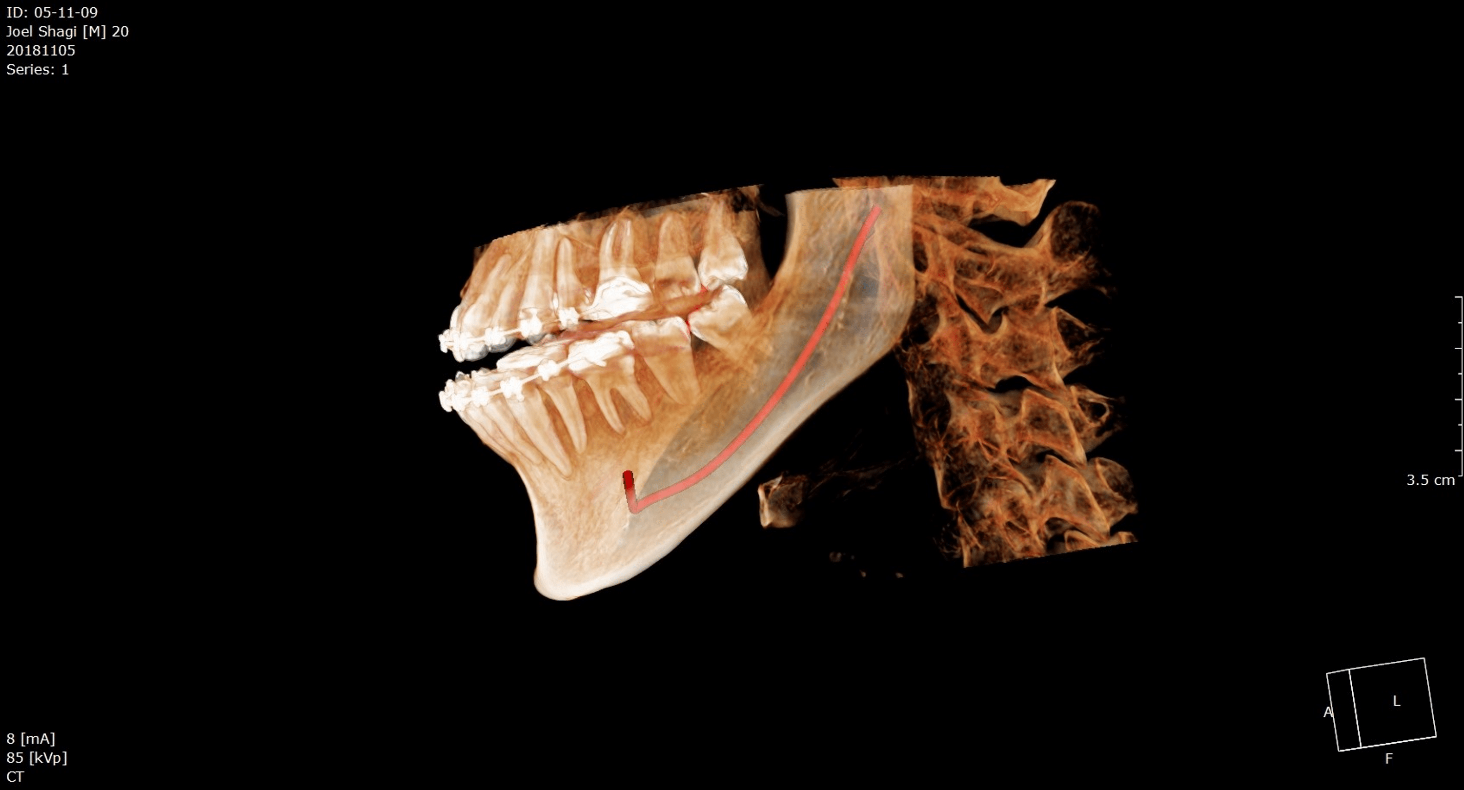 Cureus | Assessment Of Mandibular Canal Using Cone-Beam Computed ...