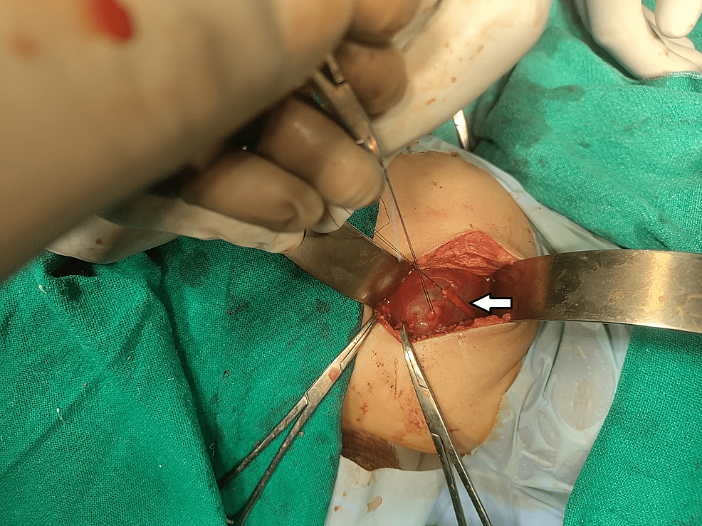 The-entire-right-ureteric-stricture-was-excised,-and-an-end-to-end-anastomosis-was-done-where-the-dilated-right-renal-pelvis-was-sutured-with-the-bladder-after-placing-a-3/12-DJ-stent.