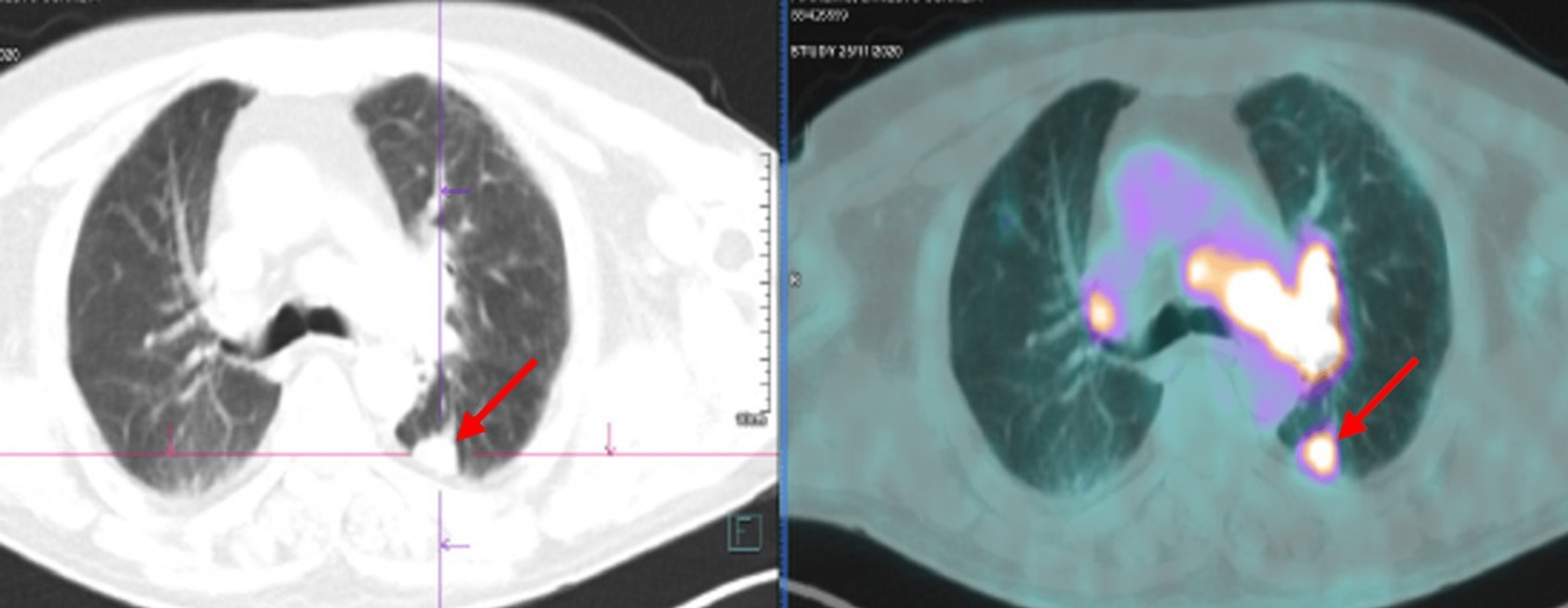 paraneoplastic presentation of small cell lung cancer