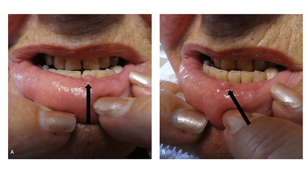 biting-fibroma-of-the-lower-lip-a-case-report-and-literature-review-on