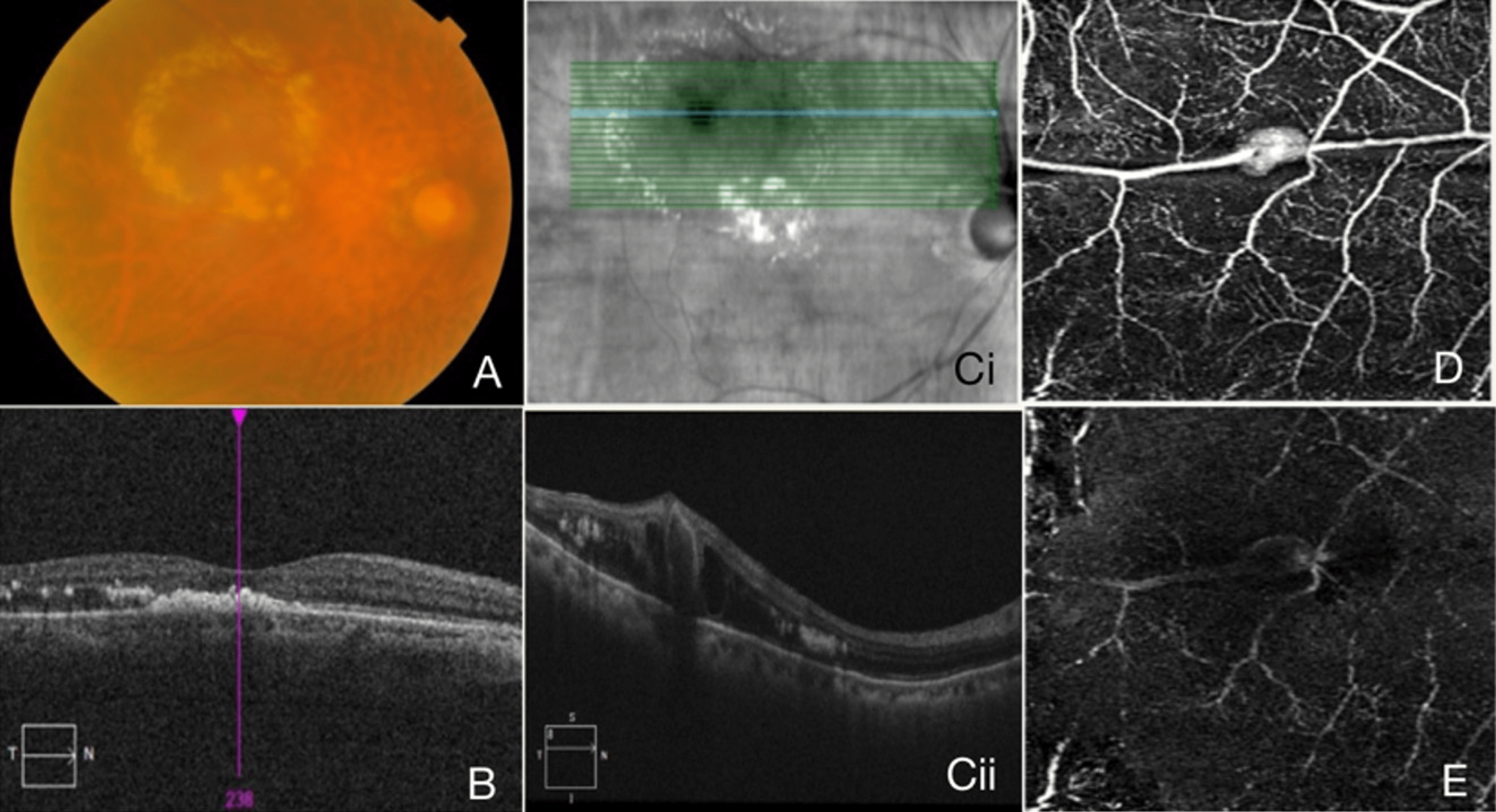 Cureus | Objective Assessment of Retinal Artery Macroaneurysm With ...