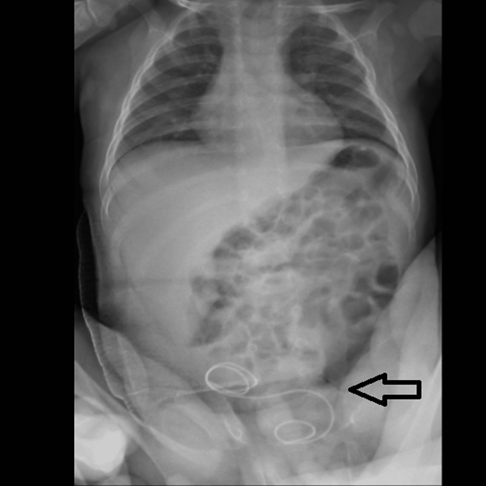 X-ray-of-the-erect-abdomen-showing-a-3/12-DJ-stent-in-situ-postoperatively.