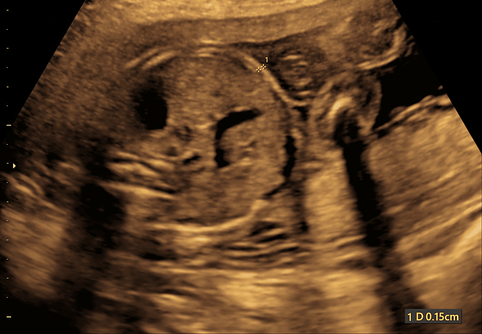 Mid-Trimester Fetal Anterior Abdominal Wall Subcutaneous Tissue Thickness: An Early Ultrasonographic Predictor of Gestational Diabetes Mellitus