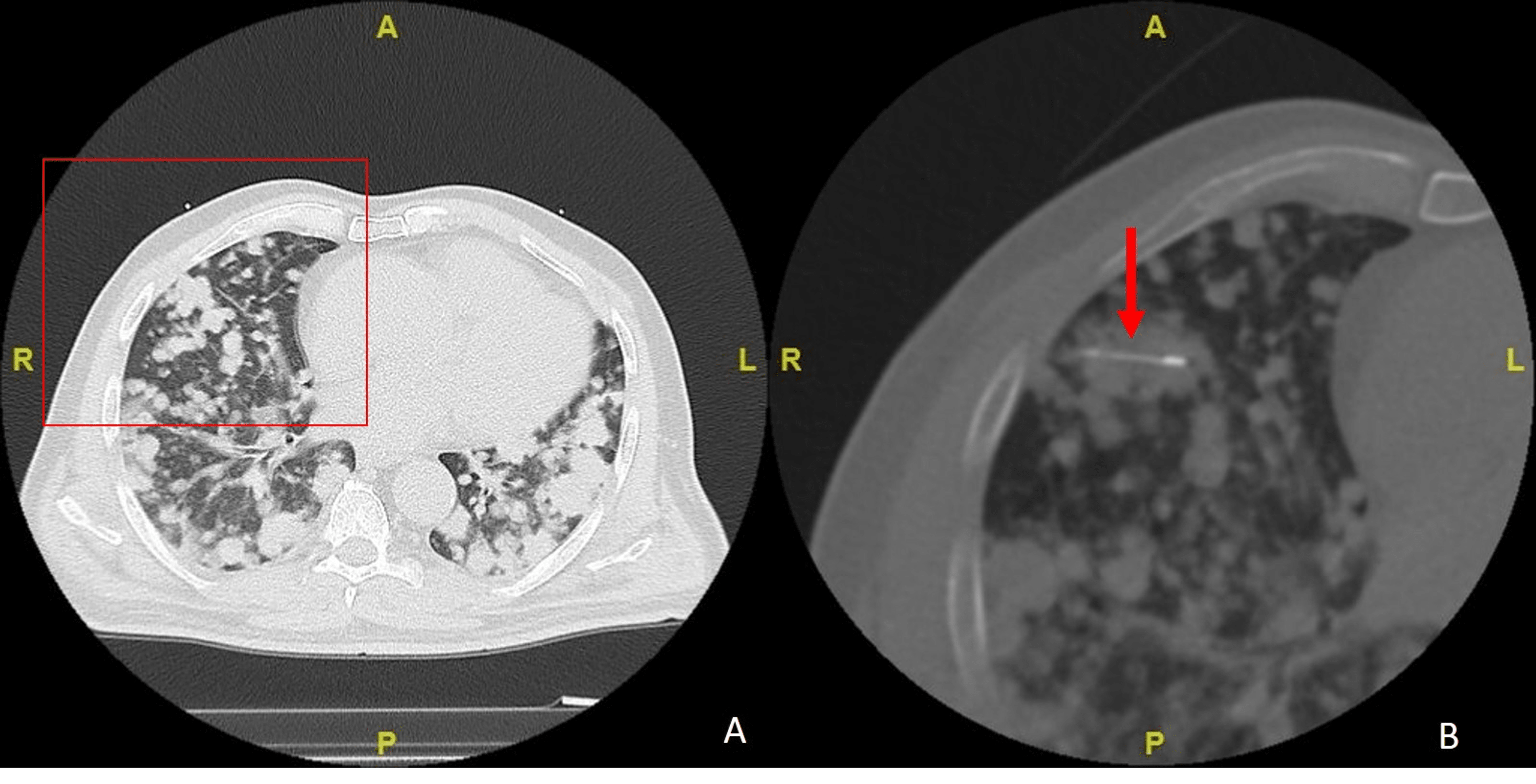 Delayed Presentation Of Air Embolism Within Cerebral Arteries Following ...