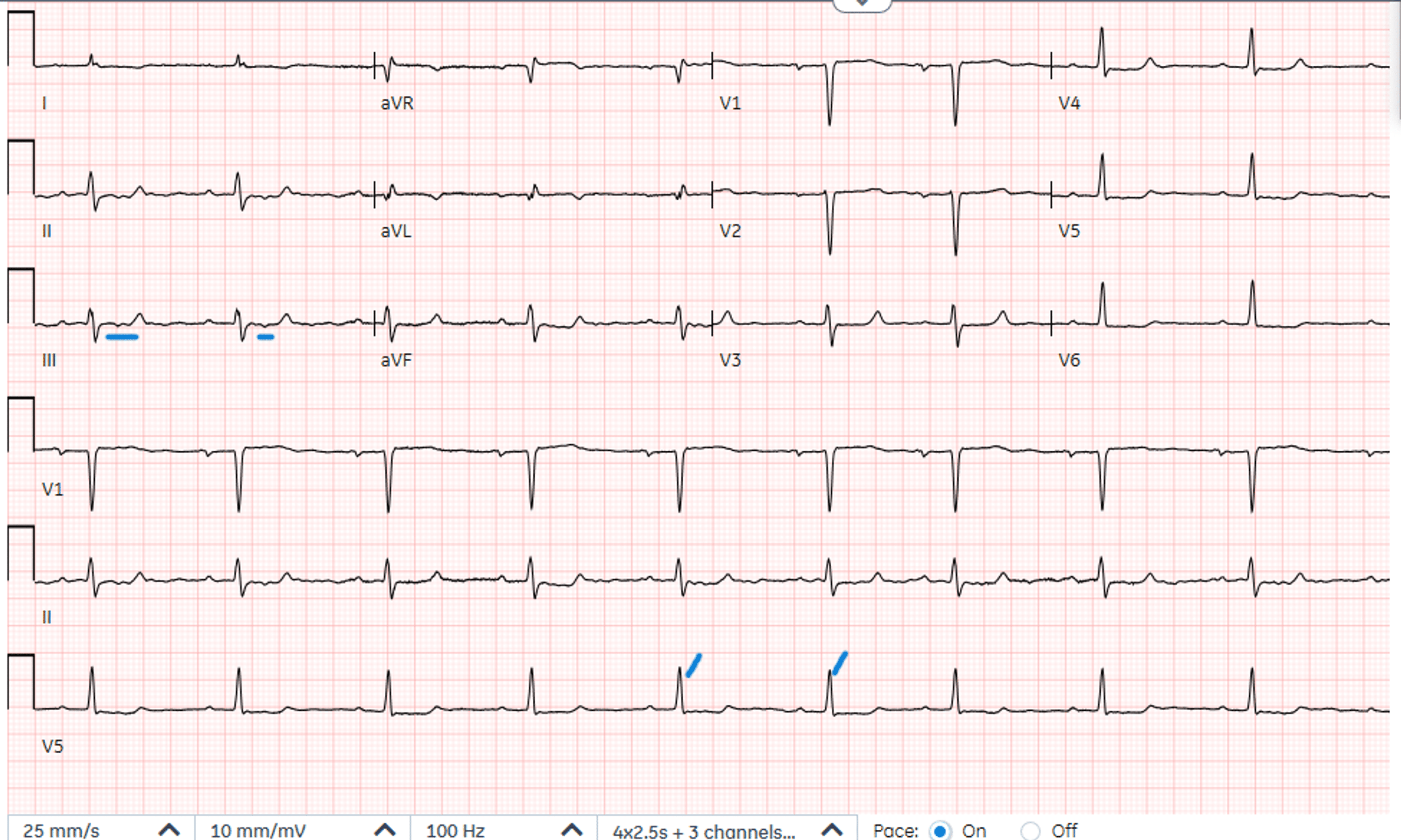 Cureus A Case Report on BRASH (Bradycardia, Renal Failure