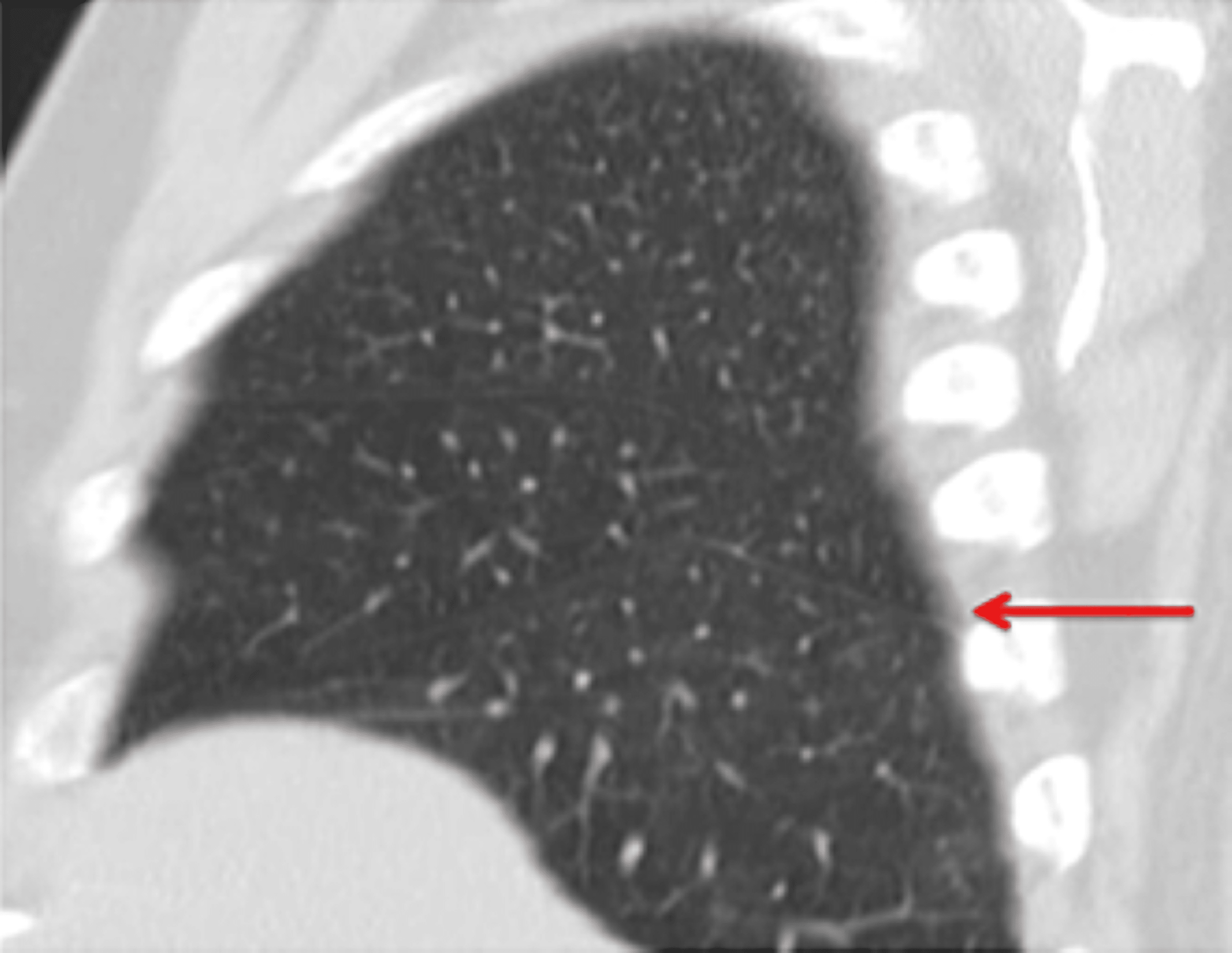 Cureus Anatomical Variations in Pulmonary Fissures on Computed