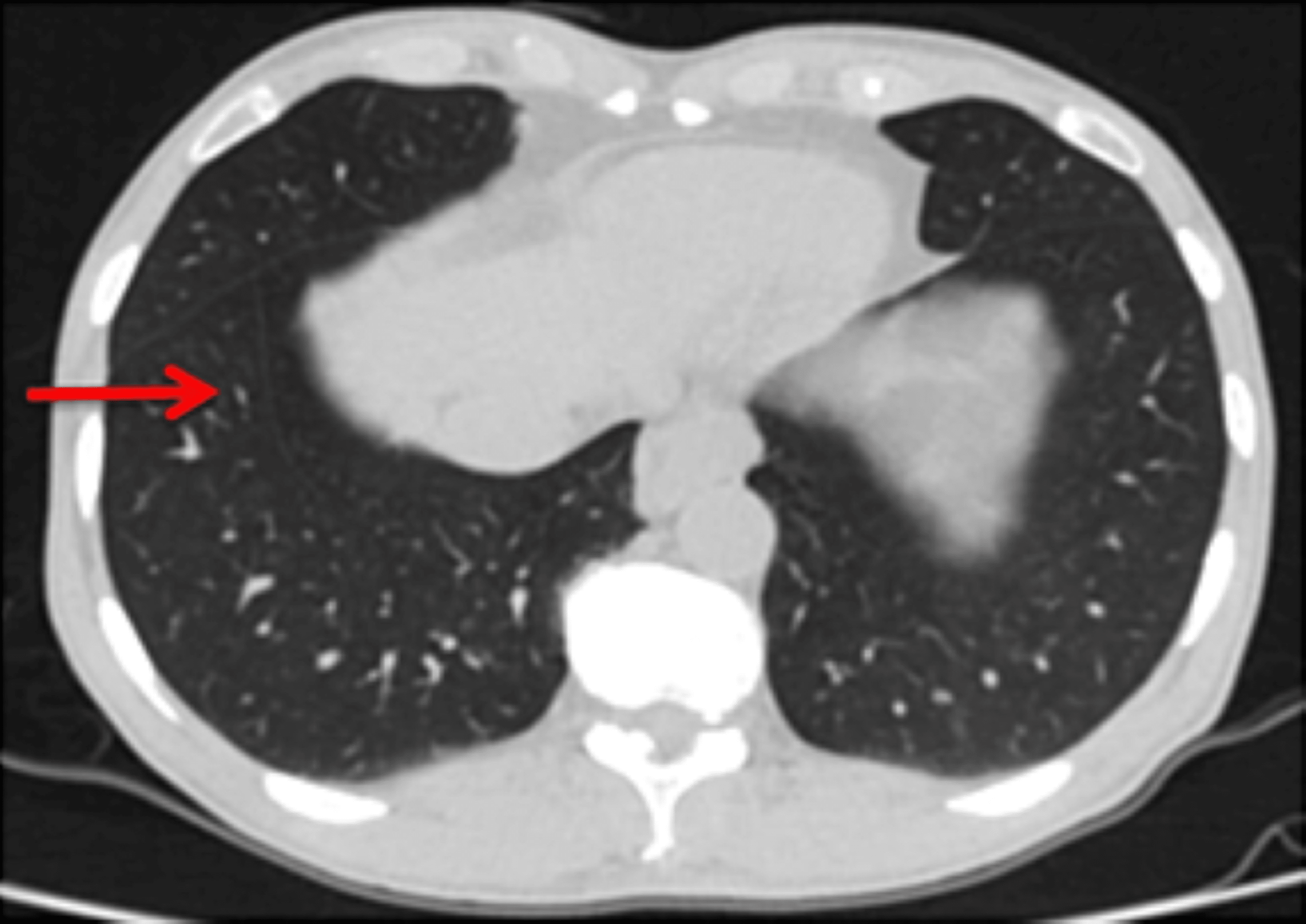 Cureus Anatomical Variations in Pulmonary Fissures on Computed