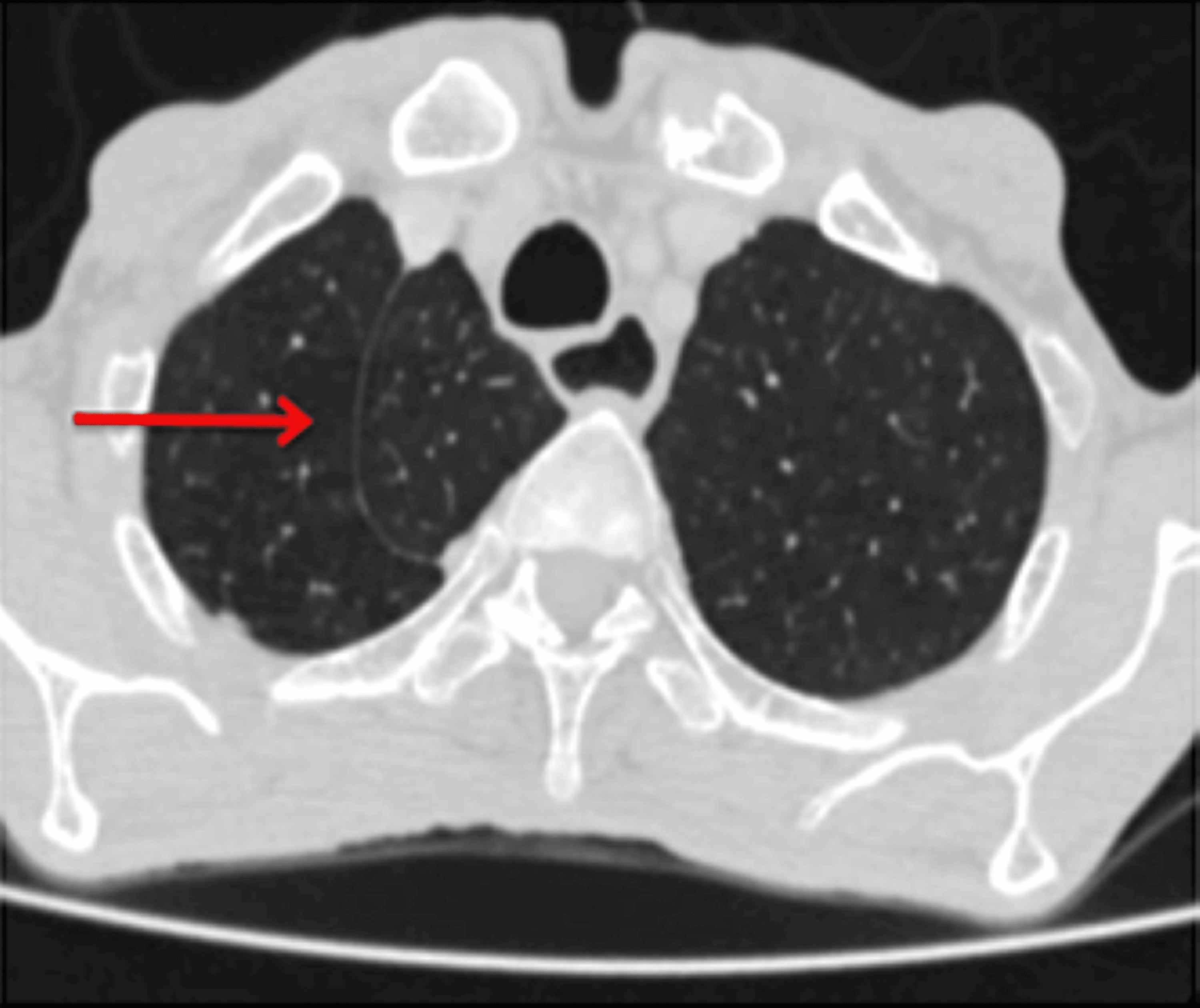 Cureus Anatomical Variations in Pulmonary Fissures on Computed