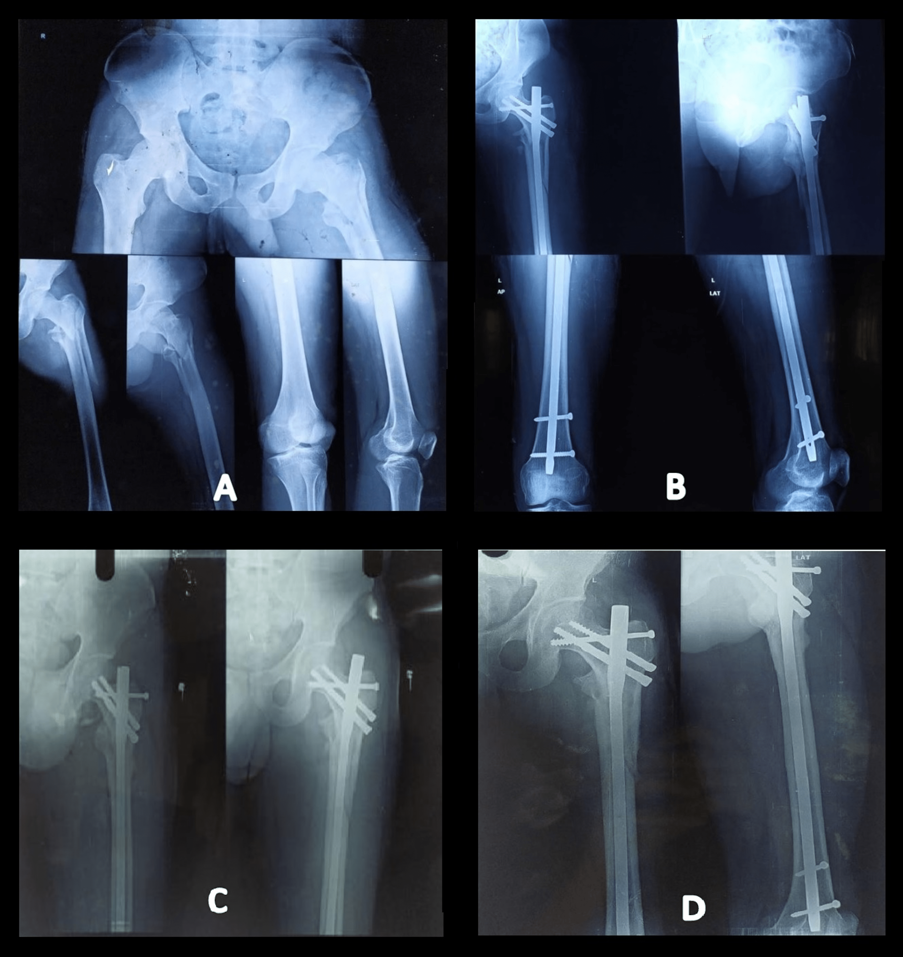 Cureus | Prospective Comparative Study Between Proximal Femoral Nail vs. Screw Augmented Proximal Femoral Nail in Unstable Intertrochanteric Fractures of Femur | Article Cureus | Prospective Comparative Study Between Proximal Femoral Nail vs. Screw Augmented Proximal Femoral Nail in Unstable Intertrochanteric Fractures of Femur | Article