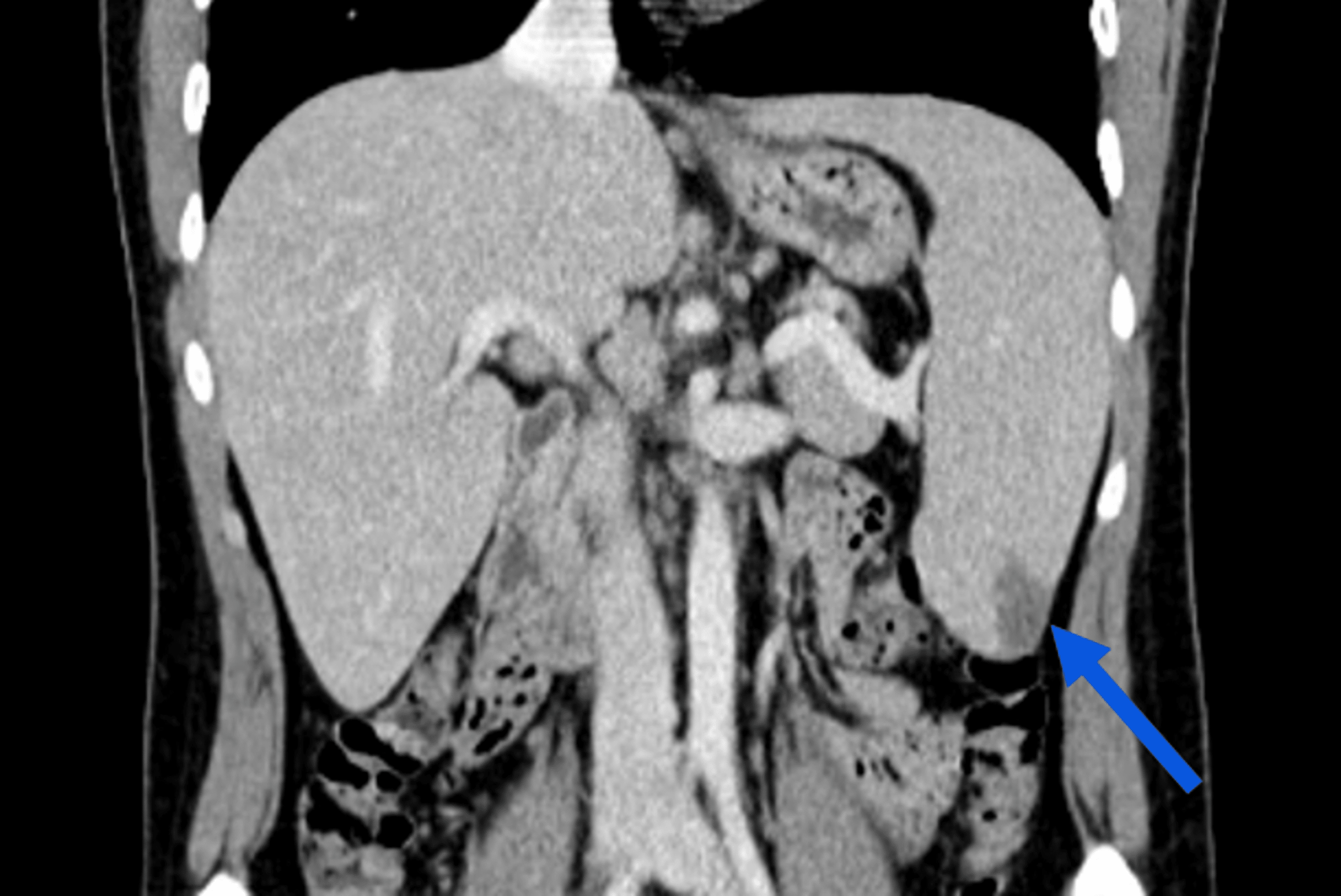Splenic Infarction A Rare Complication of Infectious Mononucleosis