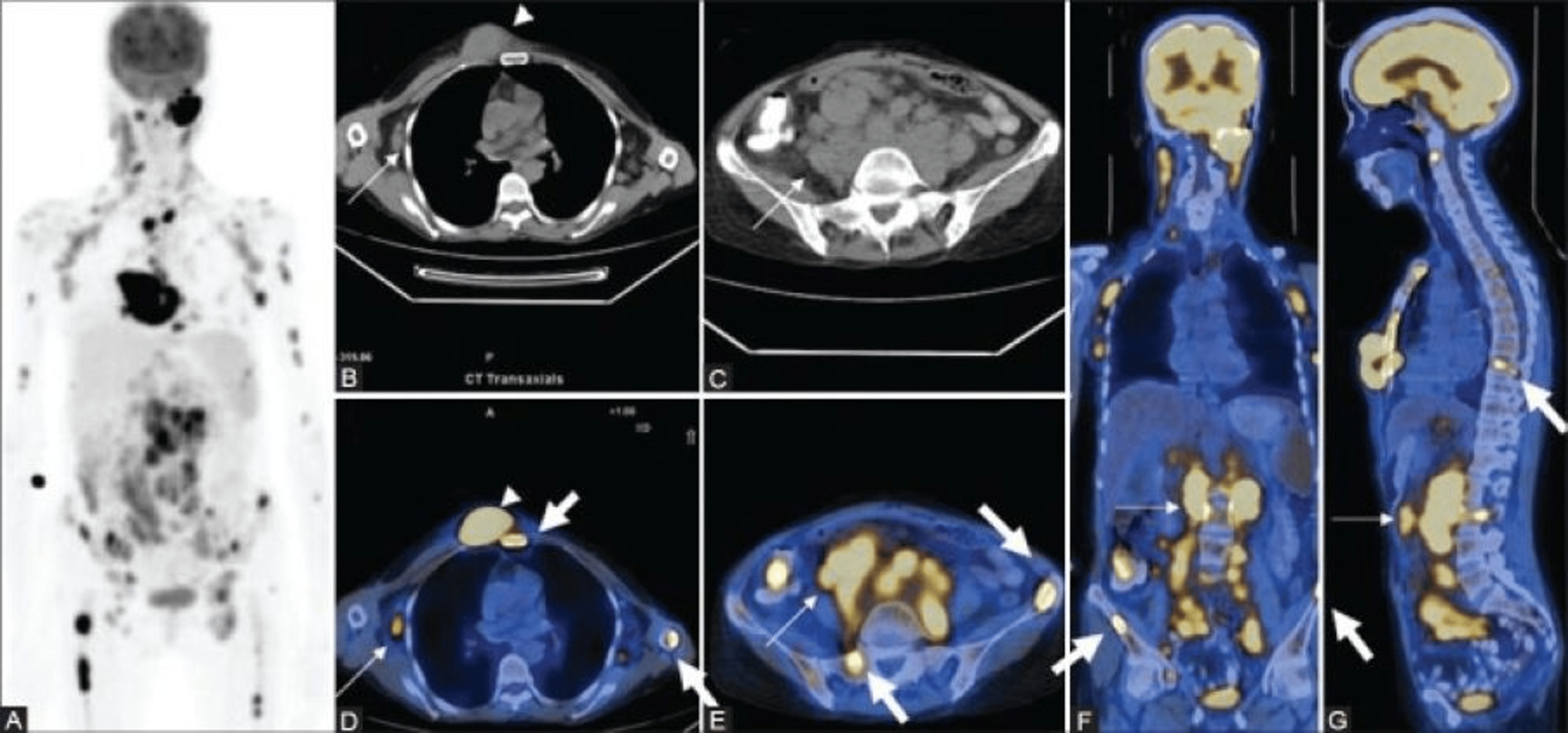 Cureus Changing Role of PET/CT in Cancer Care With a Focus on Radiotherapy
