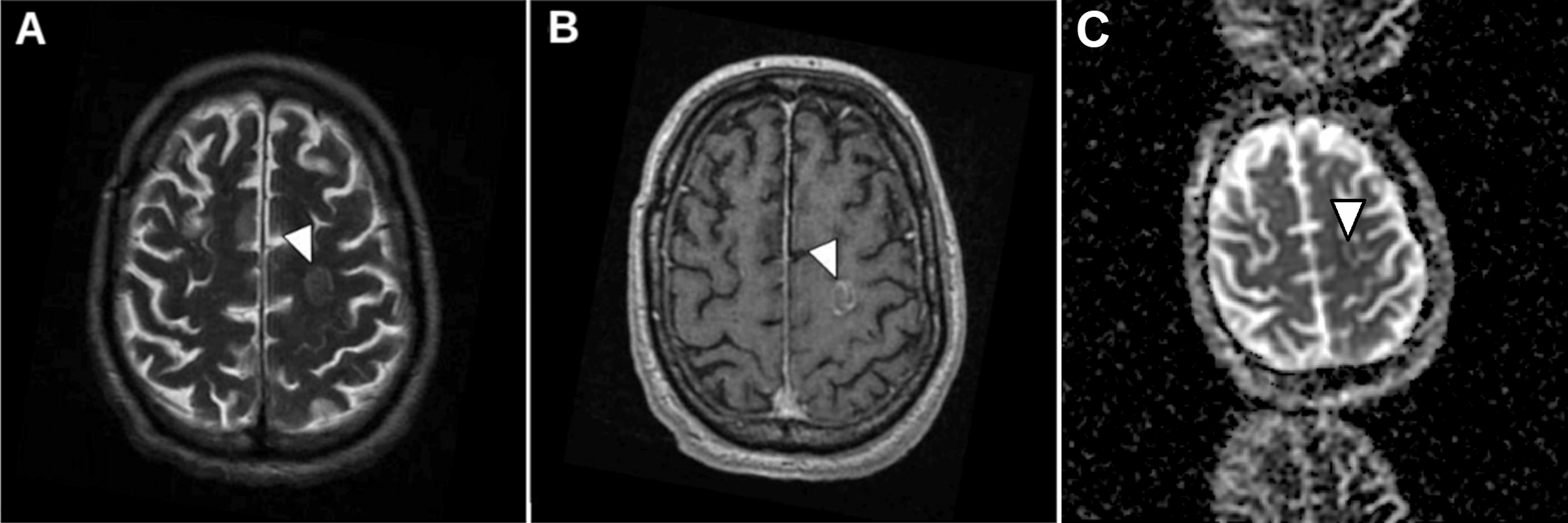 Cureus Fungal Endocarditis A Rare Case of Multiple Arterial Embolization