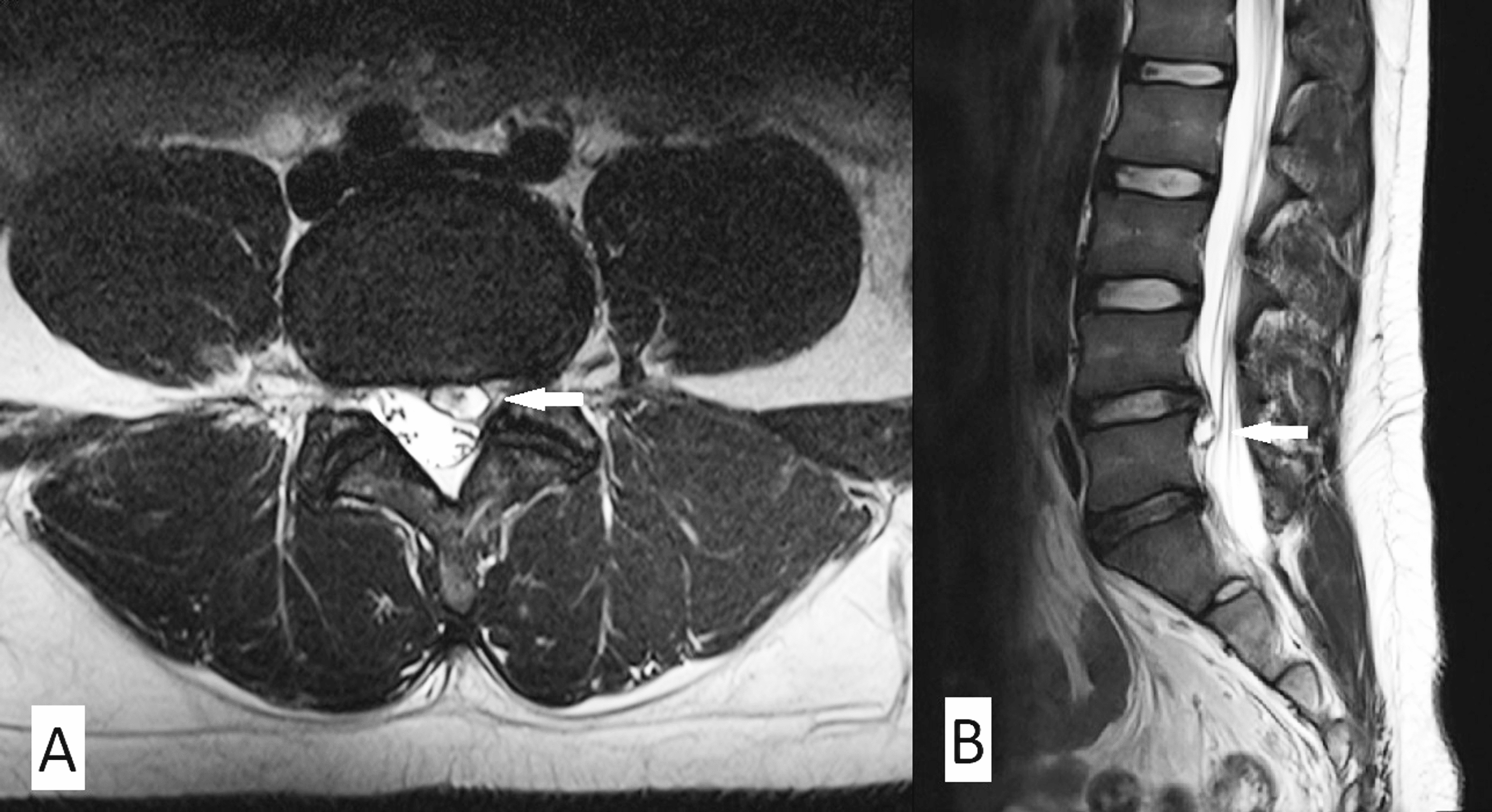 Cureus Discal Cyst, a Physical Risk A Case Report on Endoscopic Resection