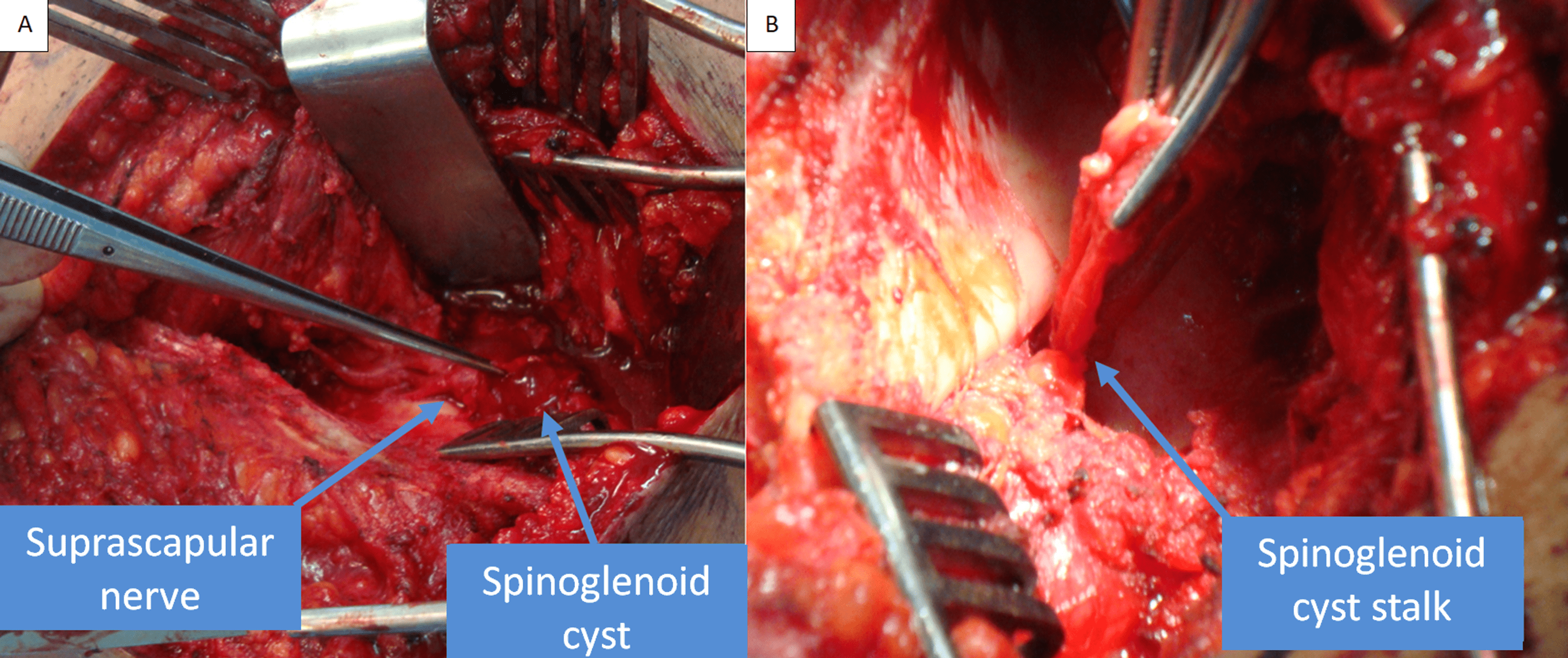 Cureus Suprascapular Nerve Compression Secondary to a Spinoglenoid