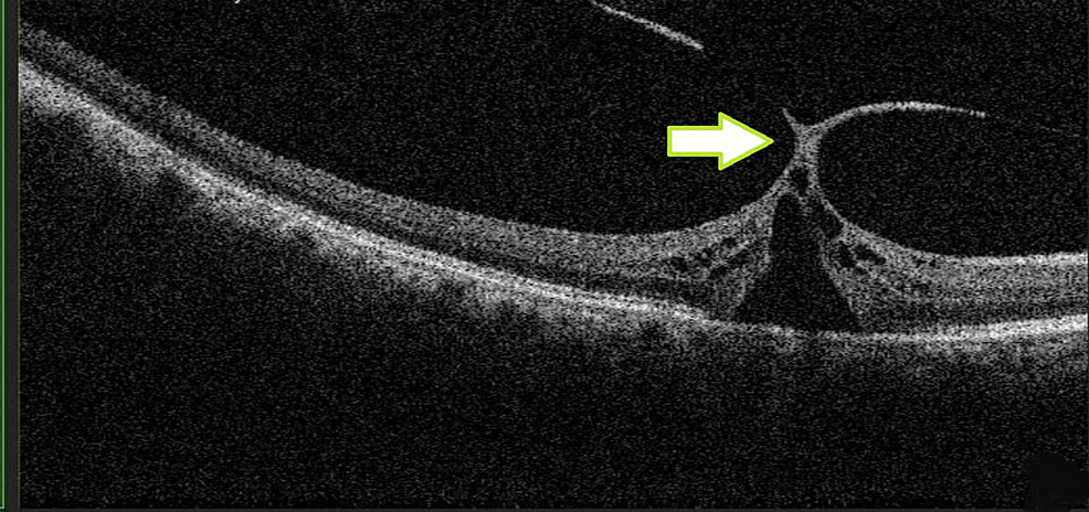vitreomacular traction oct