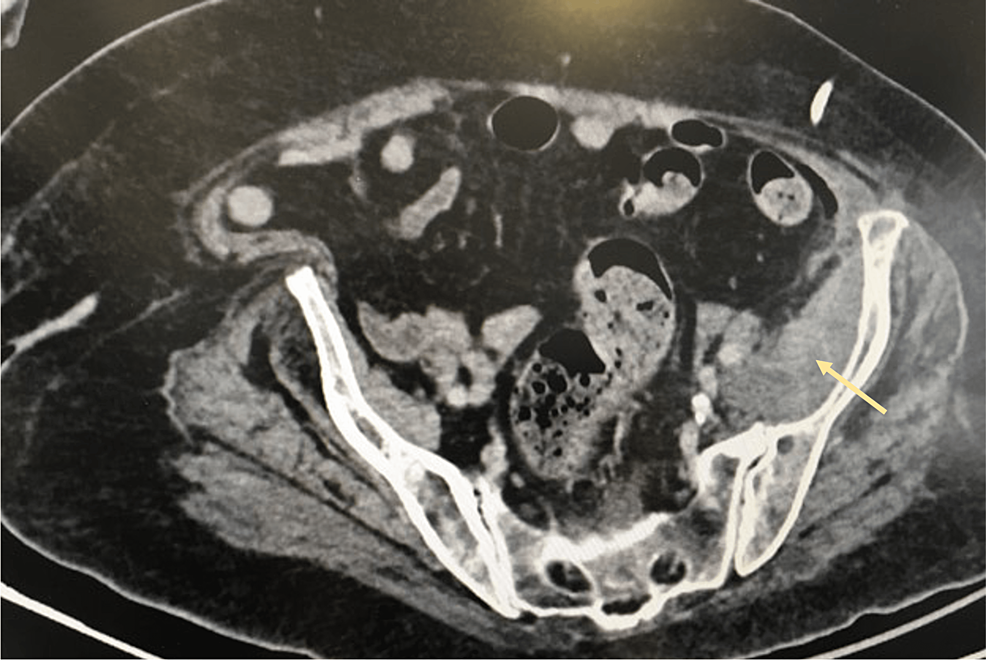 Cushing's Syndrome Behind Hypokalemia and Severe Infection A Case