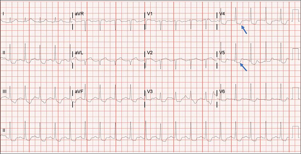 Cureus | An Overlooked Cause of Myocardial Infarction With Normal ...