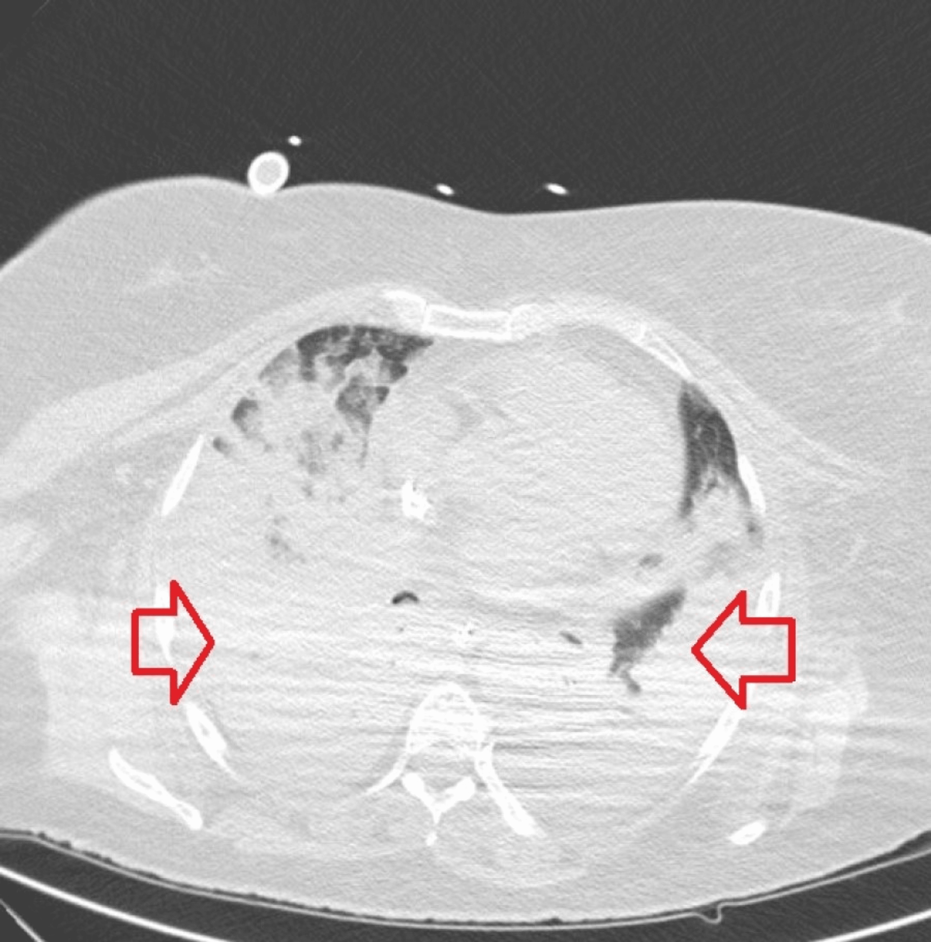 Corticosteroid Therapy in Severe Cases of Pneumonia Caused by SARSCoV