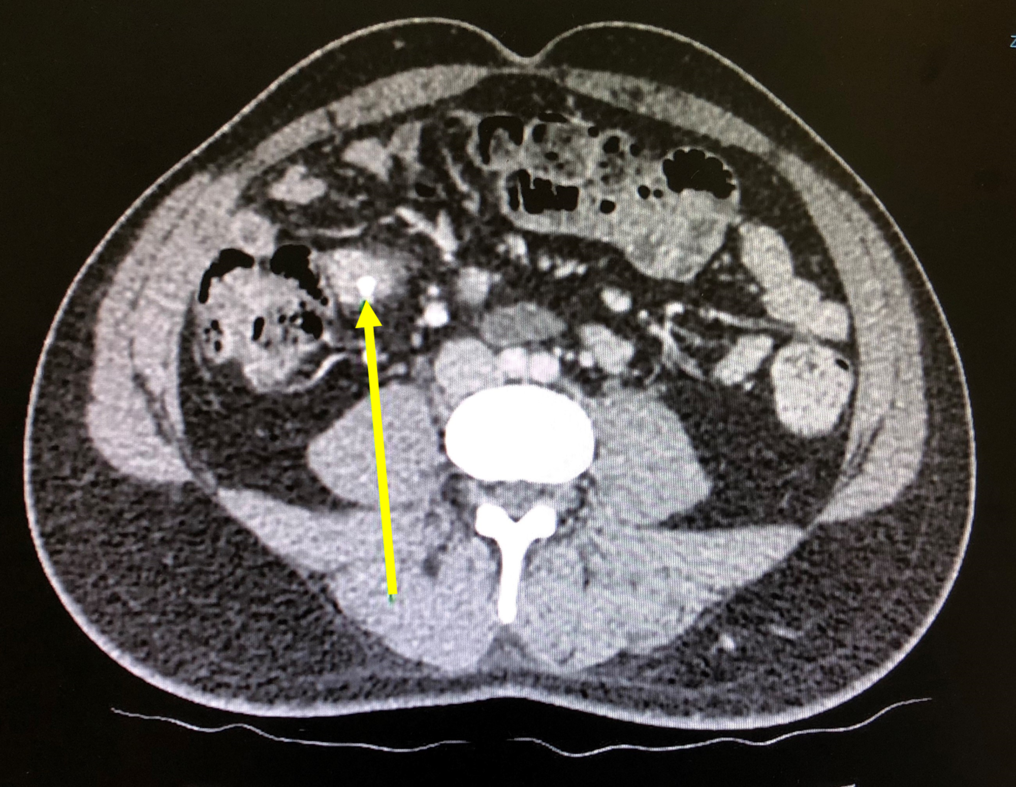 Cureus Perforated Giant Meckel's Diverticulum Mimicking Colonic Ischemia