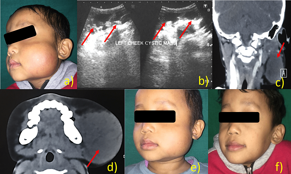 Cureus | Lymphangioma of the Oral and Maxillofacial Region: A Report of ...