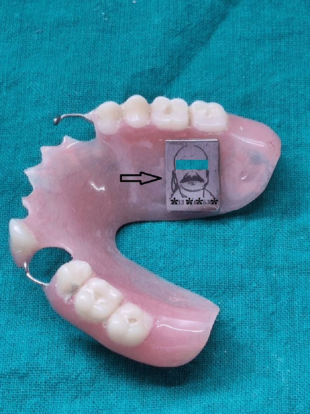 A Novel Denture Labelling Technique for Human Identification Cureus