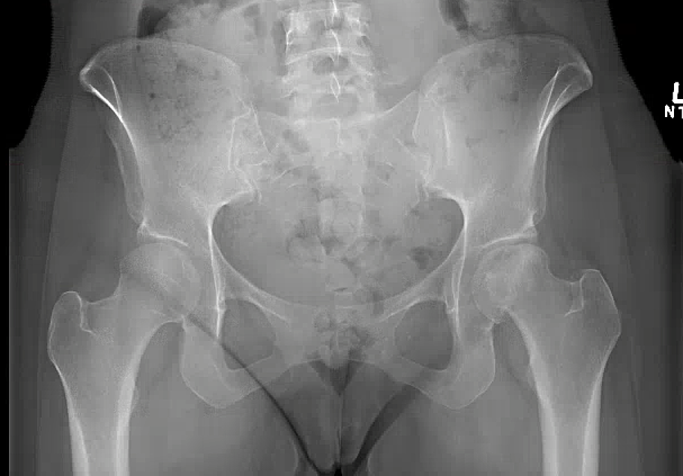 Cureus Bilateral Osteonecrosis Of The Femoral Head During Pregnancy 