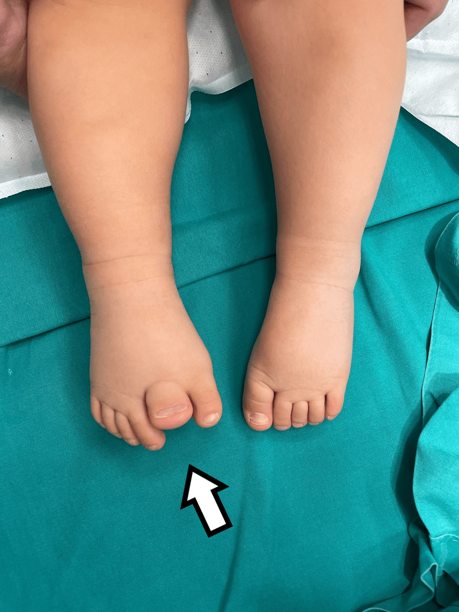 A Seven Toes Foot Case Series as an Isolated Dysplasia With Variety of