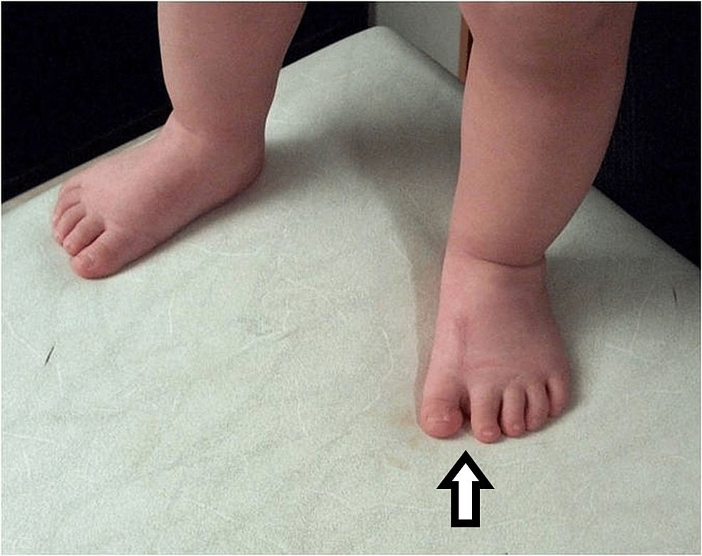 Cureus A Seven Toes Foot Case Series as an Isolated Dysplasia With