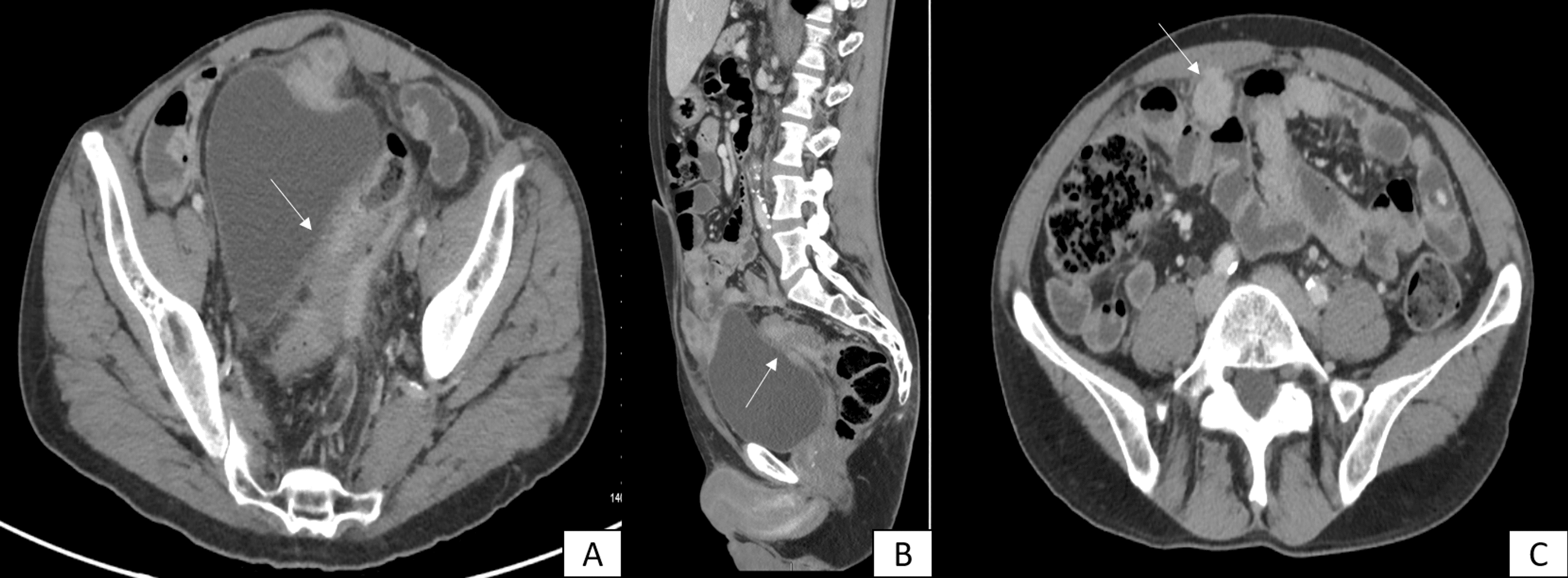 Disseminated Intraabdominal Actinomycosis Mimicking Colorectal