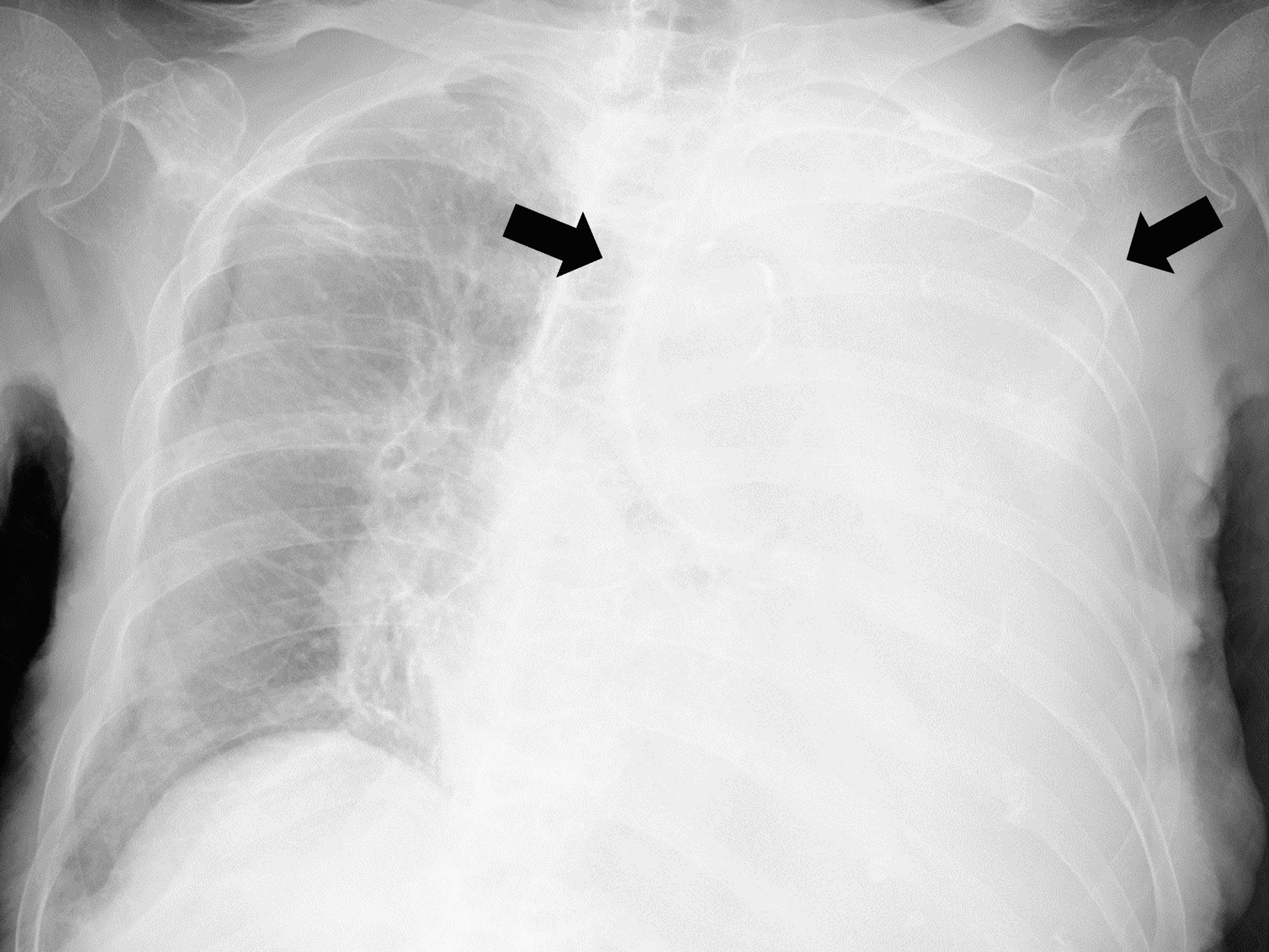 Cureus | Tuberculous Pleurisy Diagnosed From Massive Pleural Effusion ...