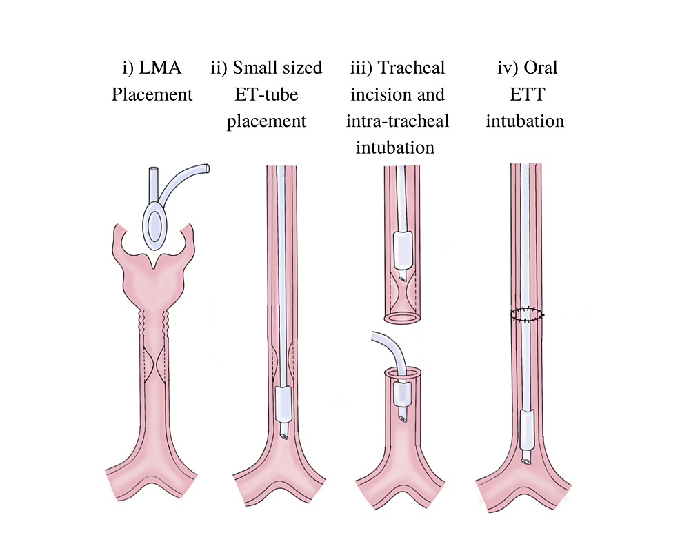Cureus Achieving Successful Extubation and CostEffective Recovery