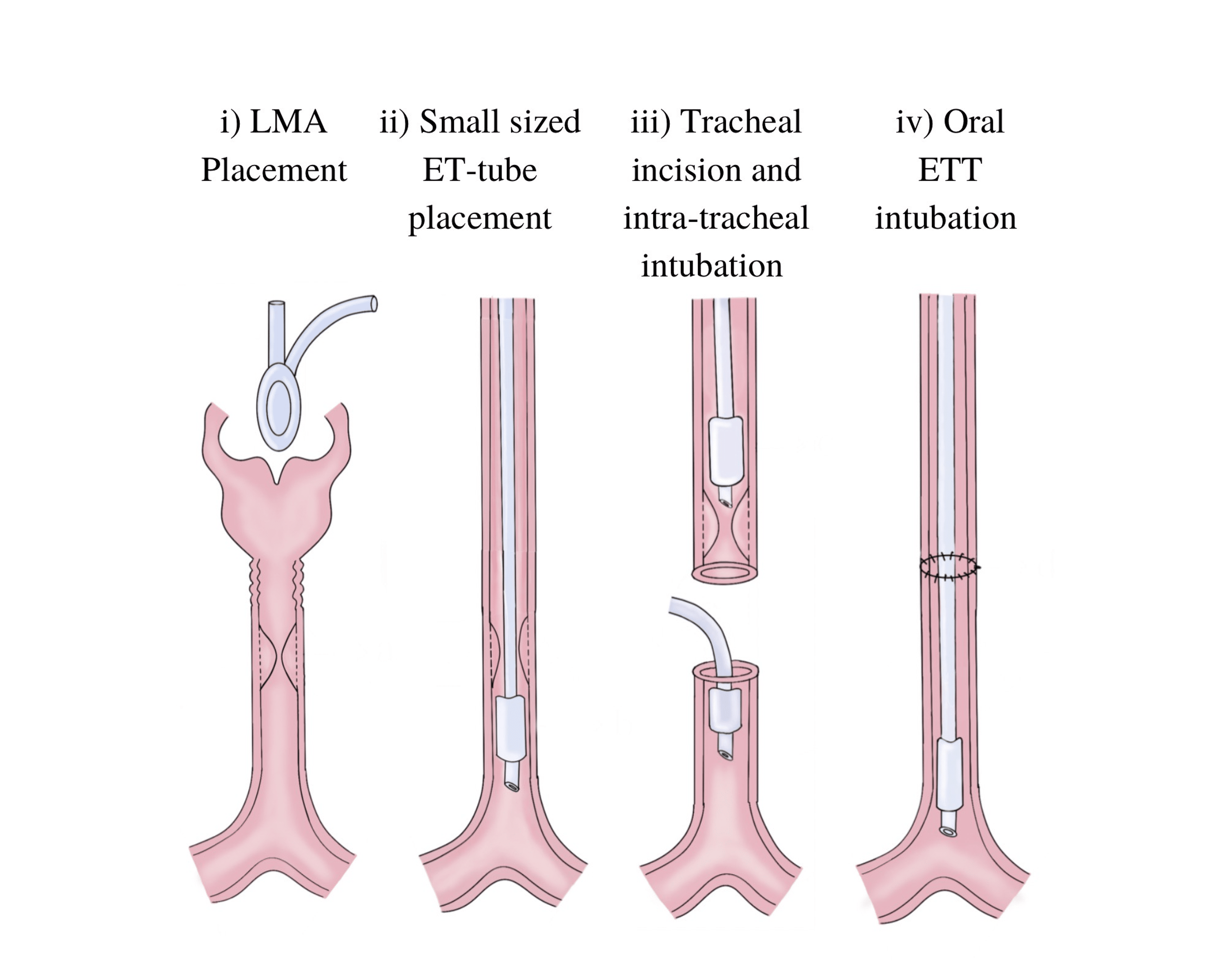 Cureus Achieving Successful Extubation and CostEffective Recovery